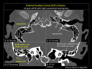 External Auditory Canal (EAC) Atresia :
14 year old M with right conductive hearing loss.
A: CT Rt axial C: CT Lft axial
B: CT Rt coronal D: CT Lft
coronal
Absent EAC
Absent EAC
Small malleus and
middle ear cavity
Normal EAC
Normal size malleus/incus
and middle ear cavity
Click to Return to Algorithm
 