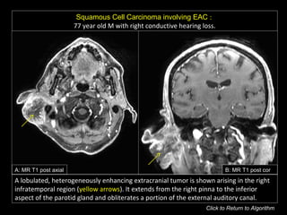 Squamous Cell Carcinoma involving EAC :
77 year old M with right conductive hearing loss.
A: MR T1 post axial B: MR T1 post cor
A lobulated, heterogeneously enhancing extracranial tumor is shown arising in the right
infratemporal region (yellow arrows). It extends from the right pinna to the inferior
aspect of the parotid gland and obliterates a portion of the external auditory canal.
Click to Return to Algorithm
 