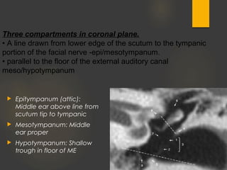  Epitympanum (attic):
Middle ear above line from
scutum tip to tympanic
 Mesotympanum: Middle
ear proper
 Hypotympanum: Shallow
trough in floor of ME
Three compartments in coronal plane.
• A line drawn from lower edge of the scutum to the tympanic
portion of the facial nerve -epi/mesotympanum.
• parallel to the floor of the external auditory canal
meso/hypotympanum
 