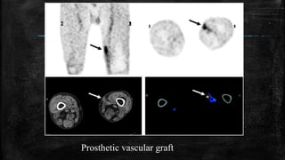 Prosthetic vascular graft
 