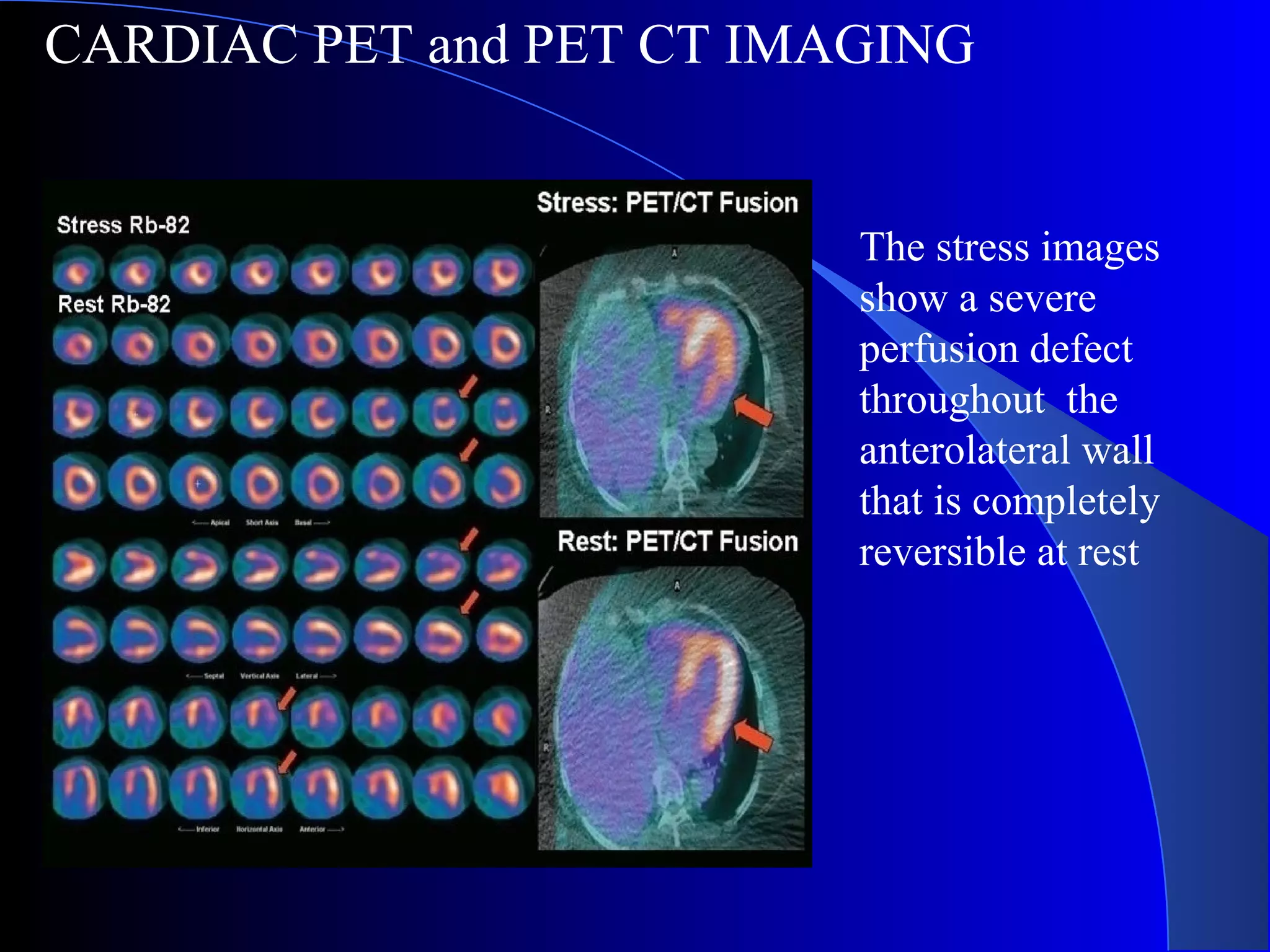 CARDIAC PET and PET CT IMAGING
The stress images
show a severe
perfusion defect
throughout the
anterolateral wall
that is completely
reversible at rest
 