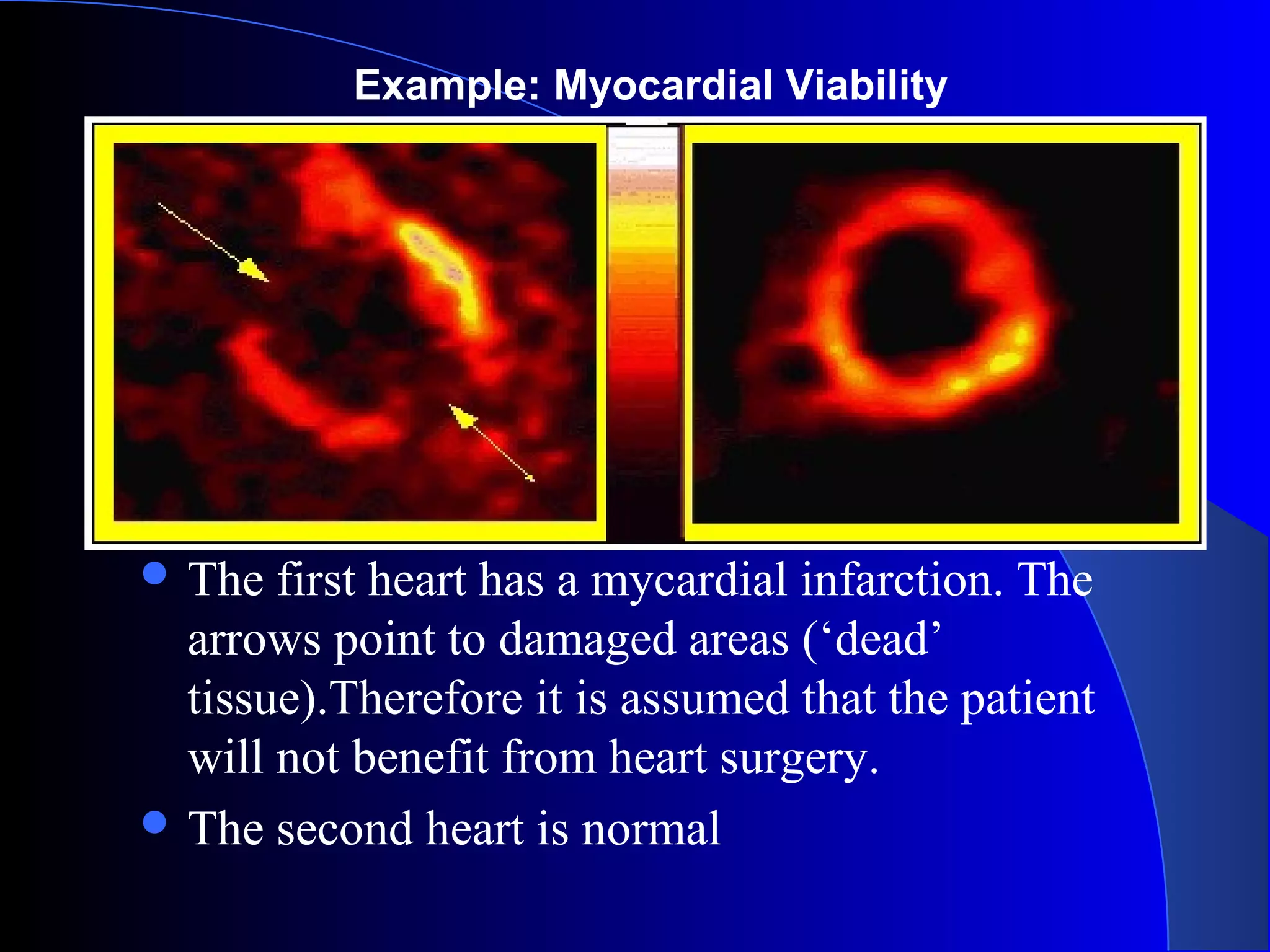  The first heart has a mycardial infarction. The
arrows point to damaged areas (‘dead’
tissue).Therefore it is assumed that the patient
will not benefit from heart surgery.
 The second heart is normal
Example: Myocardial Viability
 