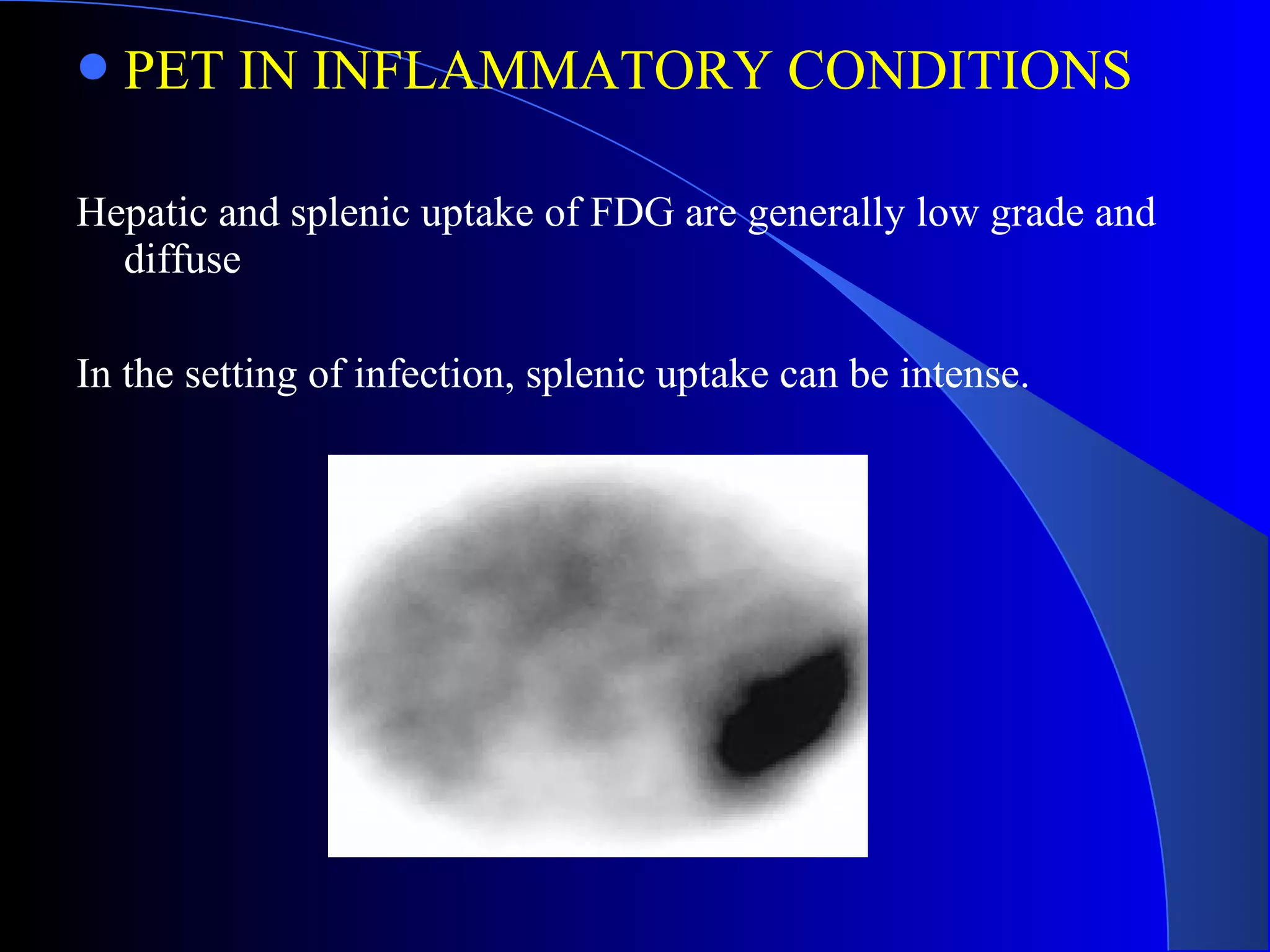 PET IN INFLAMMATORY CONDITIONS
Hepatic and splenic uptake of FDG are generally low grade and
diffuse
In the setting of infection, splenic uptake can be intense.
 