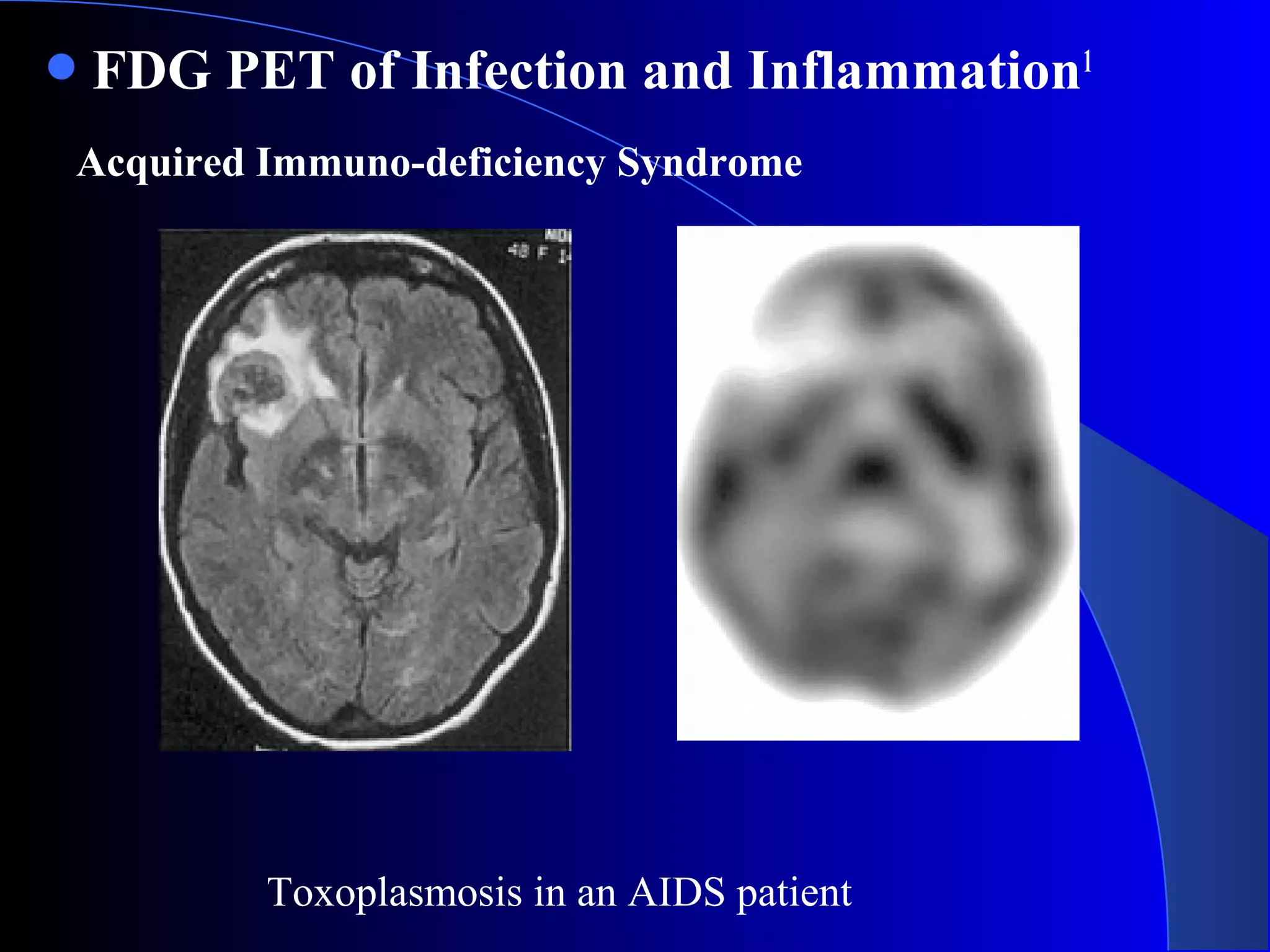 FDG PET of Infection and Inflammation1
Toxoplasmosis in an AIDS patient
Acquired Immuno-deficiency Syndrome
 