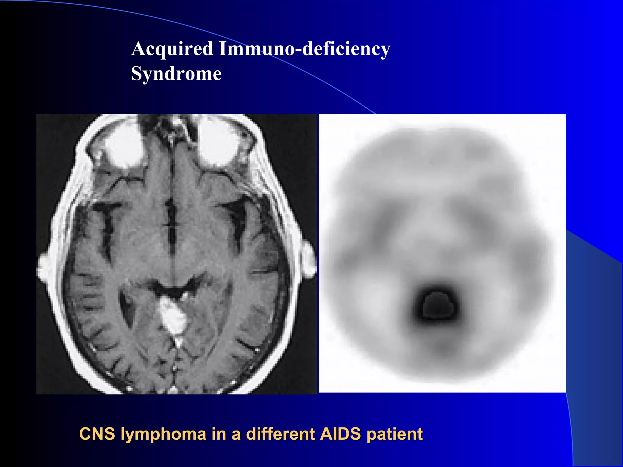 CNS lymphoma in a different AIDS patientCNS lymphoma in a different AIDS patient
Acquired Immuno-deficiency
Syndrome
 