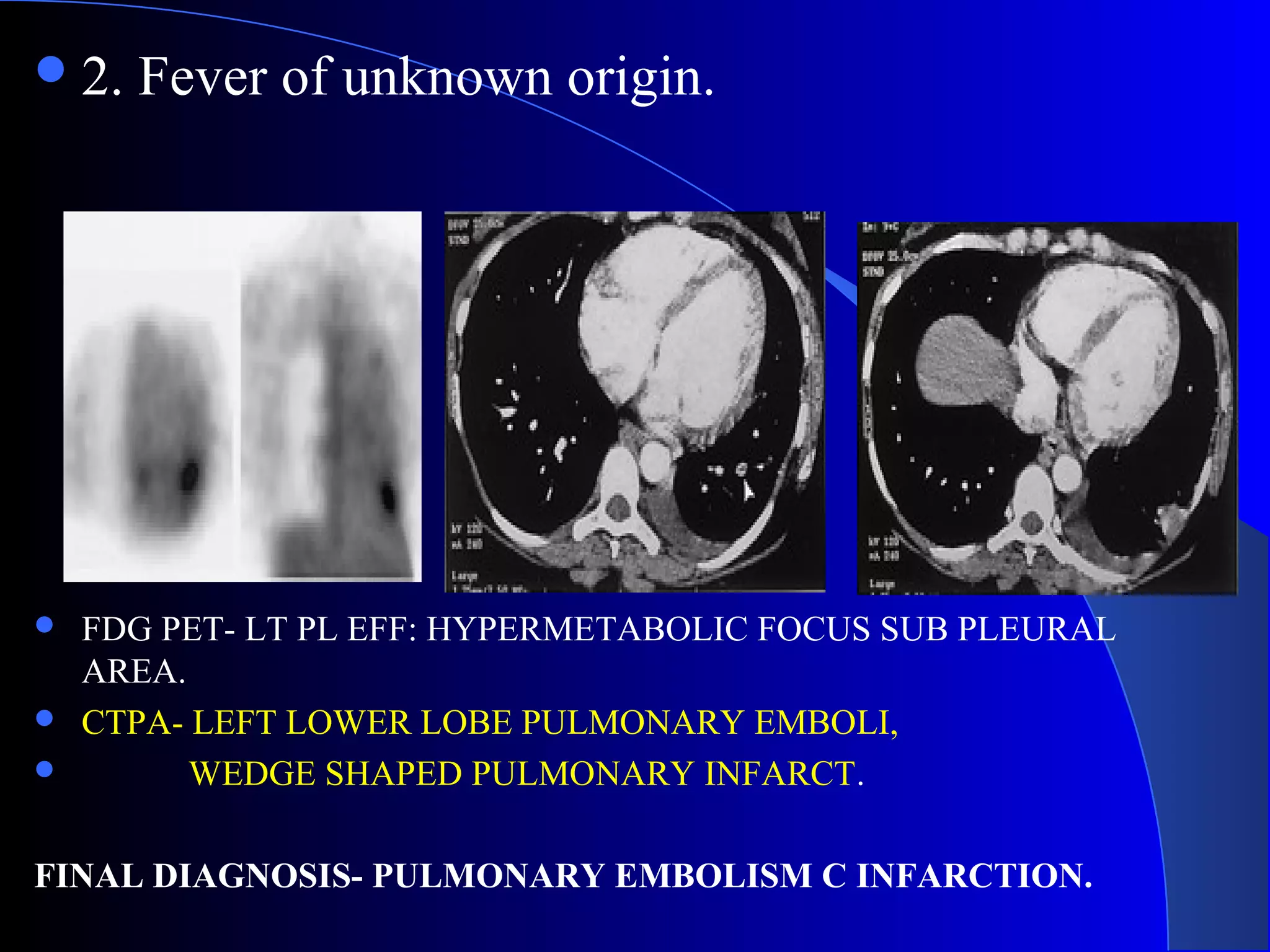 2. Fever of unknown origin.
 FDG PET- LT PL EFF: HYPERMETABOLIC FOCUS SUB PLEURAL
AREA.
 CTPA- LEFT LOWER LOBE PULMONARY EMBOLI,
 WEDGE SHAPED PULMONARY INFARCT.
FINAL DIAGNOSIS- PULMONARY EMBOLISM C INFARCTION.
 