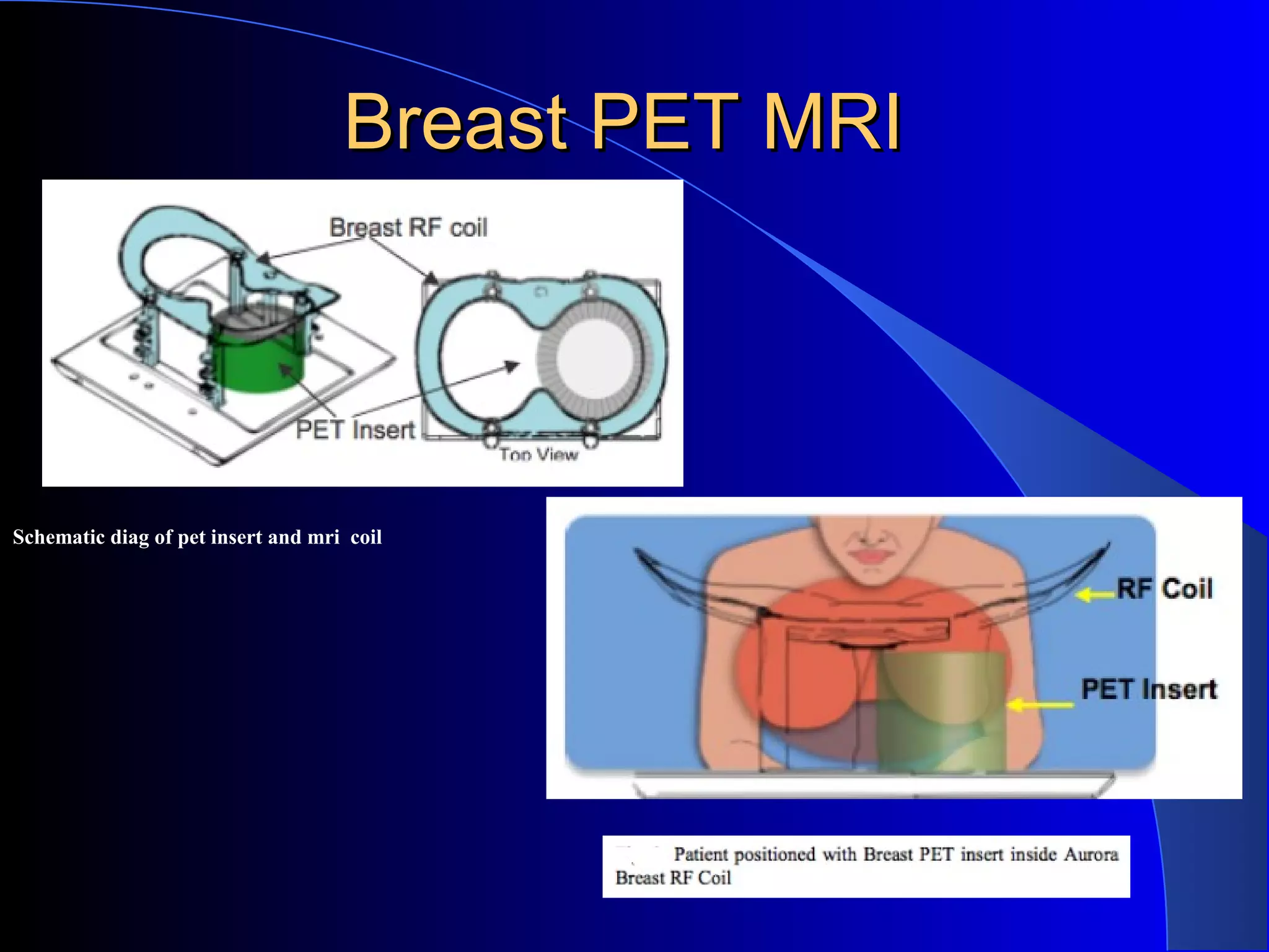 Breast PET MRIBreast PET MRI
Schematic diag of pet insert and mri coil
 