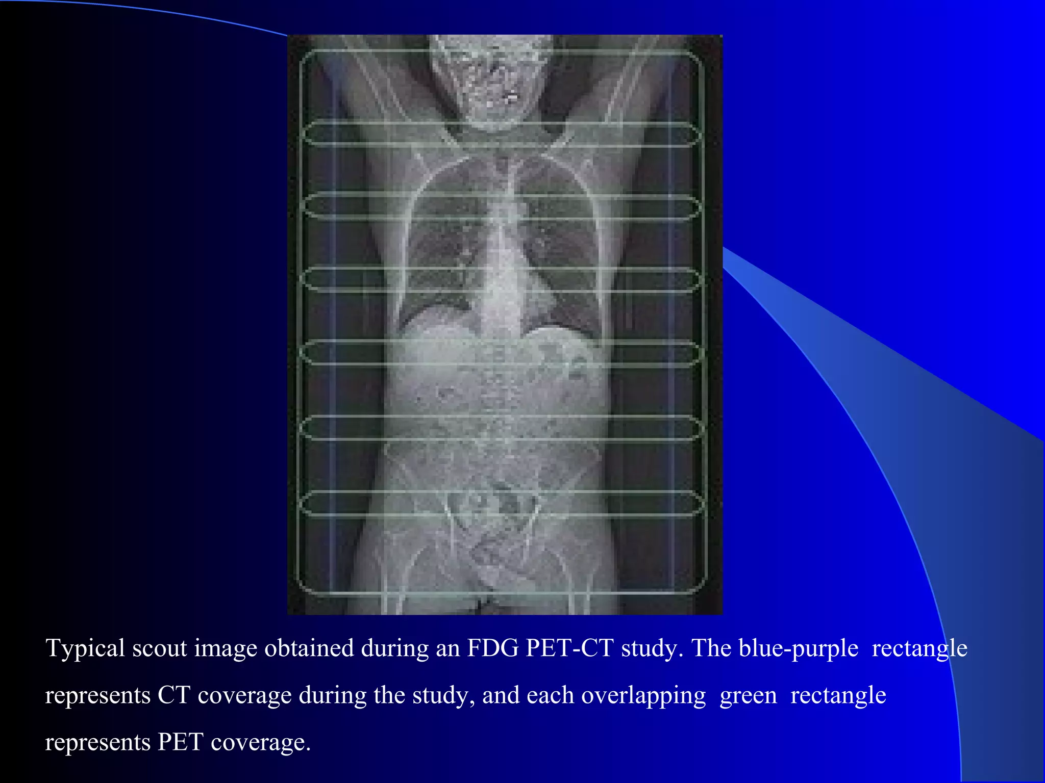 Typical scout image obtained during an FDG PET-CT study. The blue-purple rectangle
represents CT coverage during the study, and each overlapping green rectangle
represents PET coverage.
 