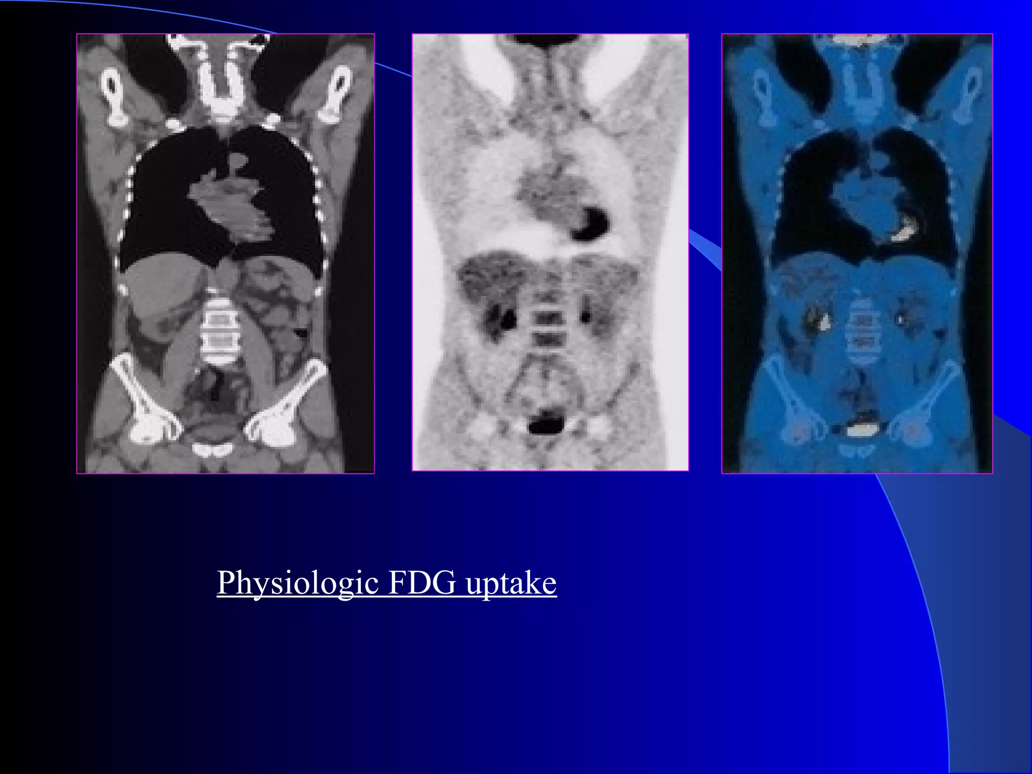Physiologic FDG uptake
 