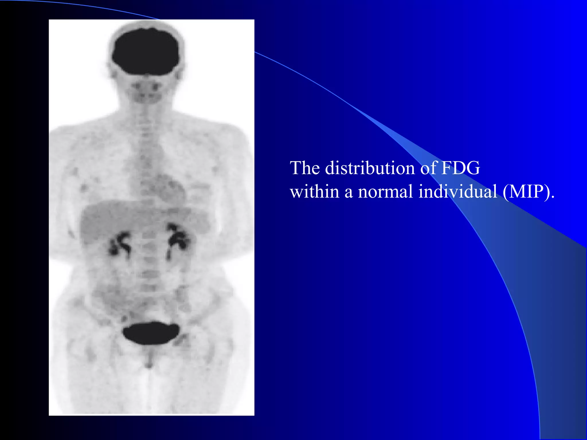 The distribution of FDG
within a normal individual (MIP).
 