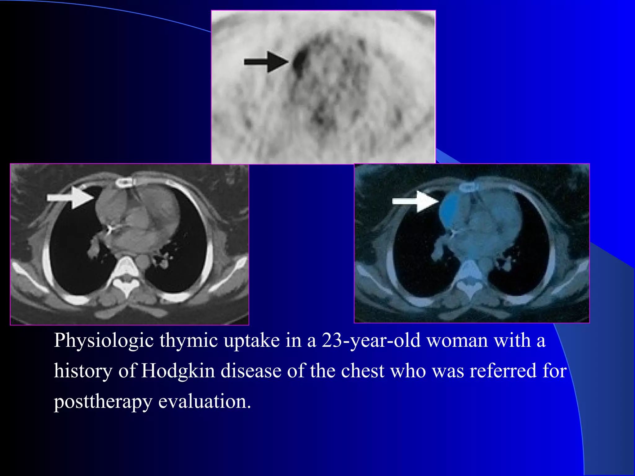 Physiologic thymic uptake in a 23-year-old woman with a
history of Hodgkin disease of the chest who was referred for
posttherapy evaluation.
 