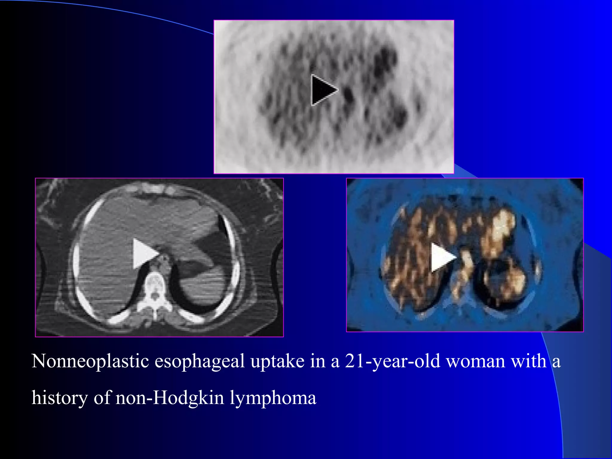 Nonneoplastic esophageal uptake in a 21-year-old woman with a
history of non-Hodgkin lymphoma
 