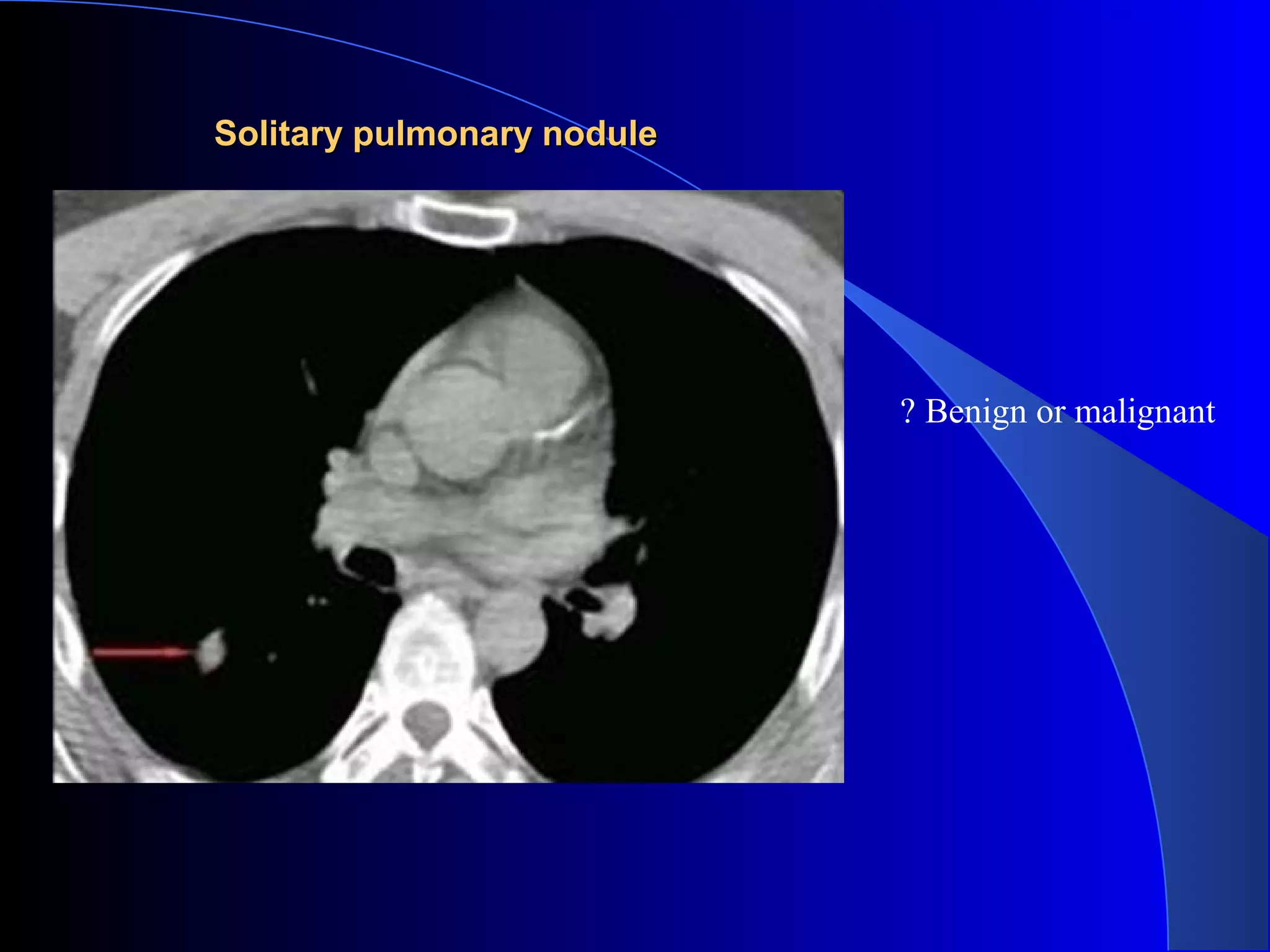 Solitary pulmonary noduleSolitary pulmonary nodule
? Benign or malignant
 