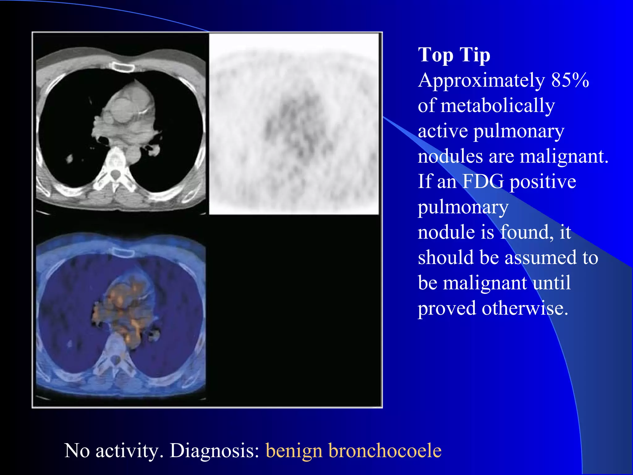 No activity. Diagnosis: benign bronchocoele
Top Tip
Approximately 85%
of metabolically
active pulmonary
nodules are malignant.
If an FDG positive
pulmonary
nodule is found, it
should be assumed to
be malignant until
proved otherwise.
 