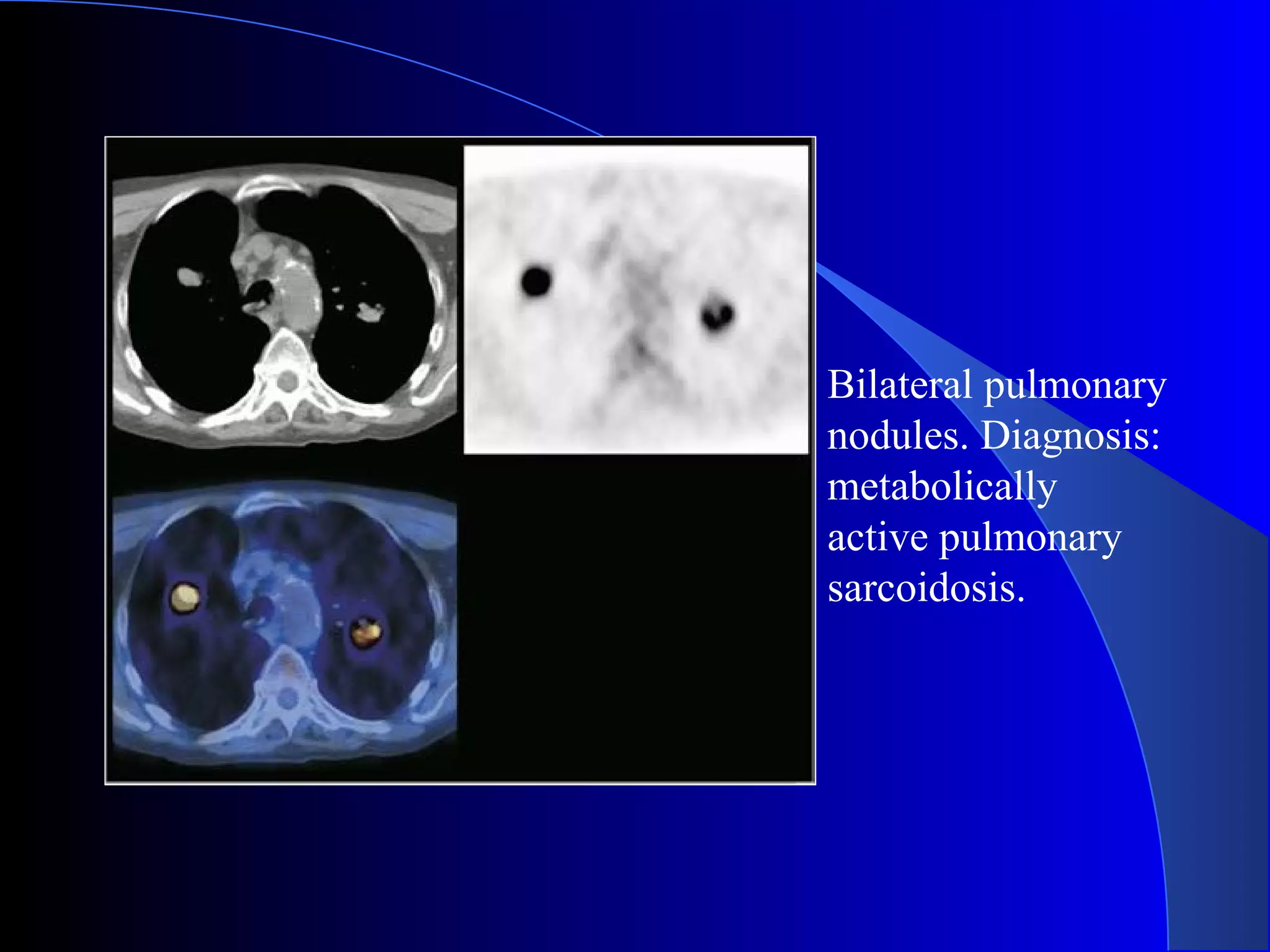 Bilateral pulmonary
nodules. Diagnosis:
metabolically
active pulmonary
sarcoidosis.
 