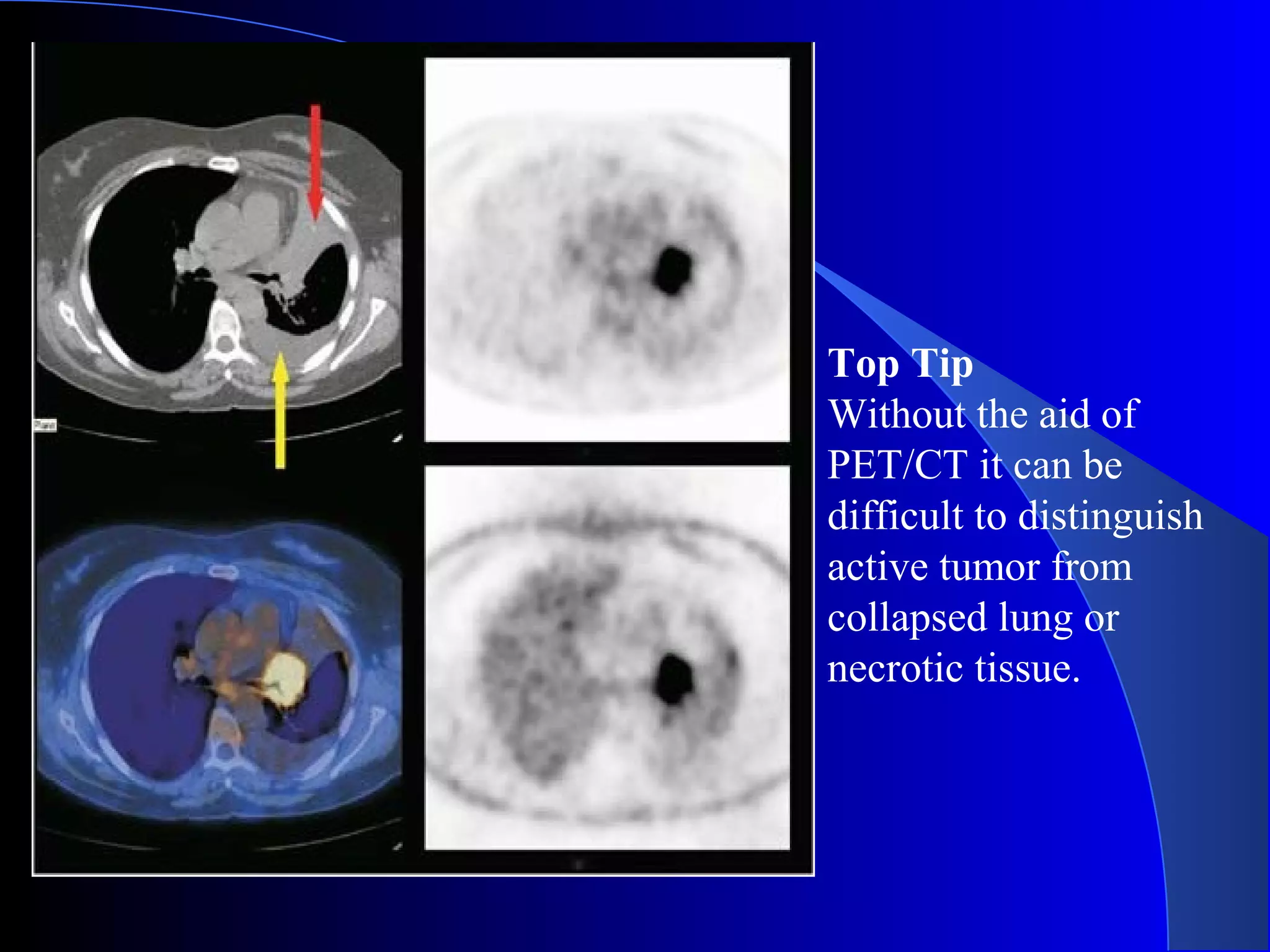 Top Tip
Without the aid of
PET/CT it can be
difficult to distinguish
active tumor from
collapsed lung or
necrotic tissue.
 