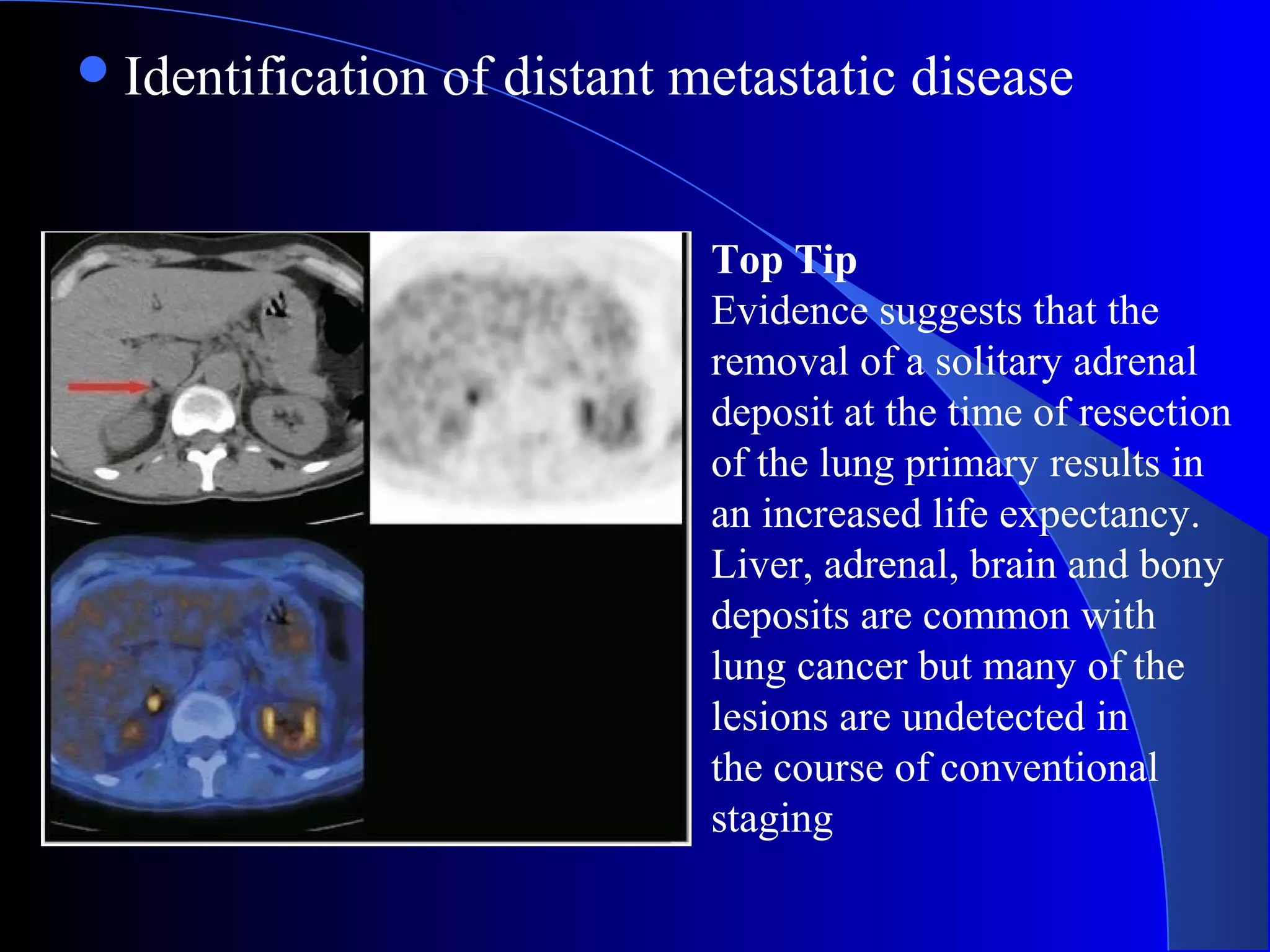 Identification of distant metastatic disease
Top Tip
Evidence suggests that the
removal of a solitary adrenal
deposit at the time of resection
of the lung primary results in
an increased life expectancy.
Liver, adrenal, brain and bony
deposits are common with
lung cancer but many of the
lesions are undetected in
the course of conventional
staging
 