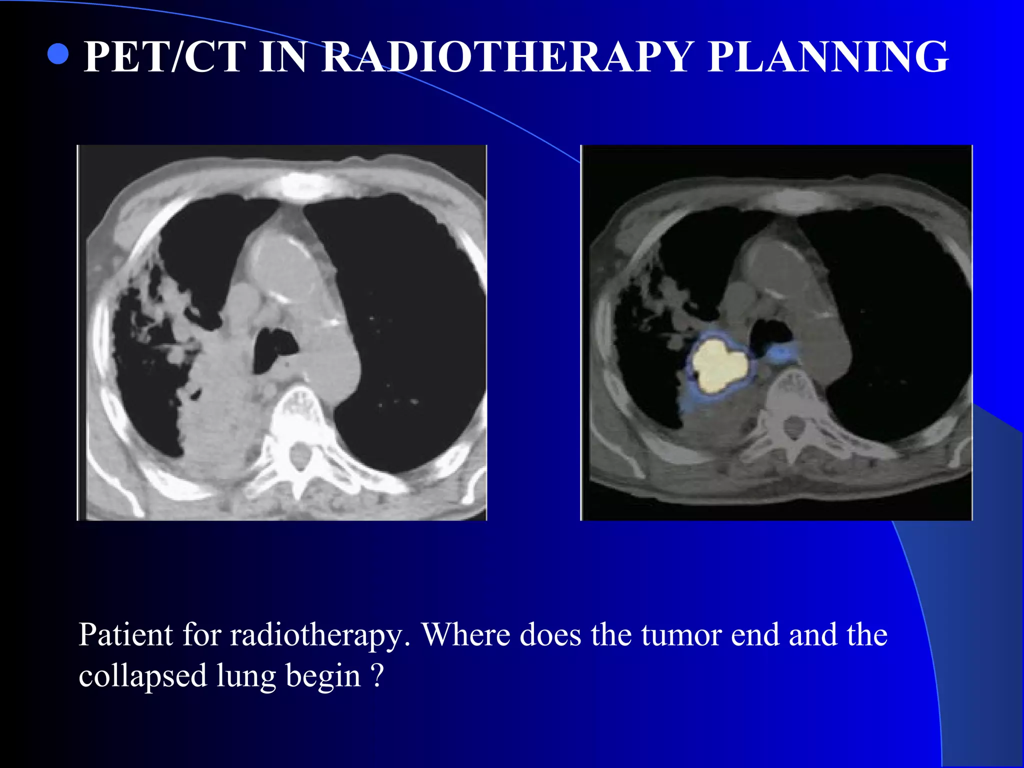 PET/CT IN RADIOTHERAPY PLANNING
Patient for radiotherapy. Where does the tumor end and the
collapsed lung begin ?
 