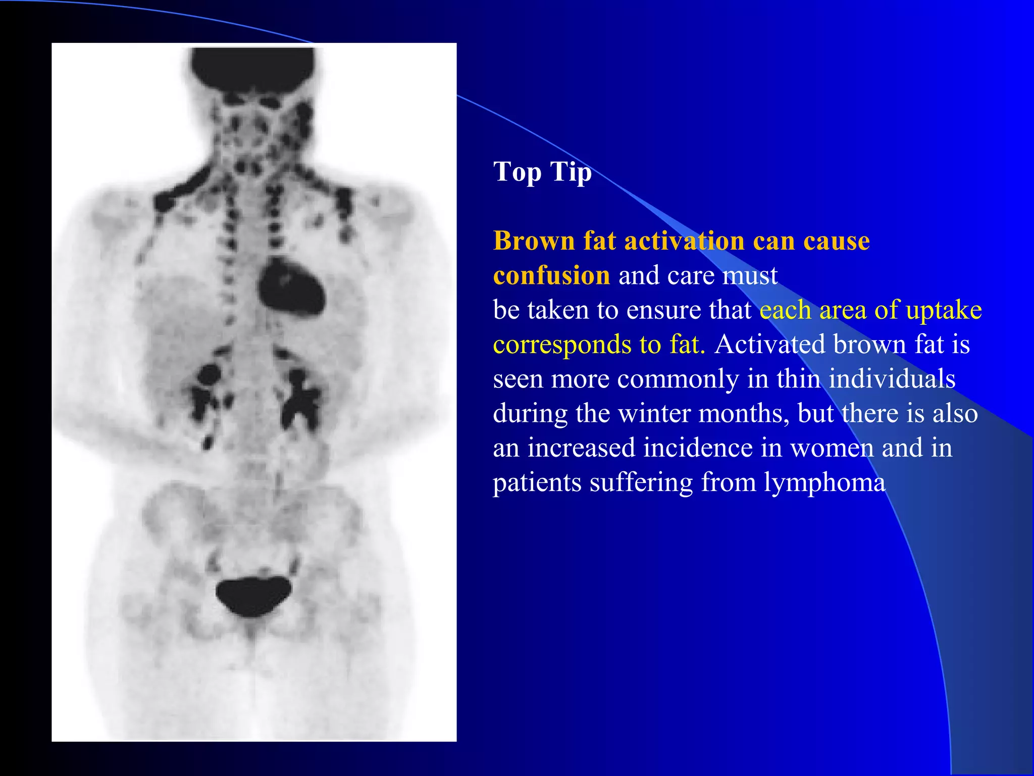 Top Tip
Brown fat activation can cause
confusion and care must
be taken to ensure that each area of uptake
corresponds to fat. Activated brown fat is
seen more commonly in thin individuals
during the winter months, but there is also
an increased incidence in women and in
patients suffering from lymphoma
 