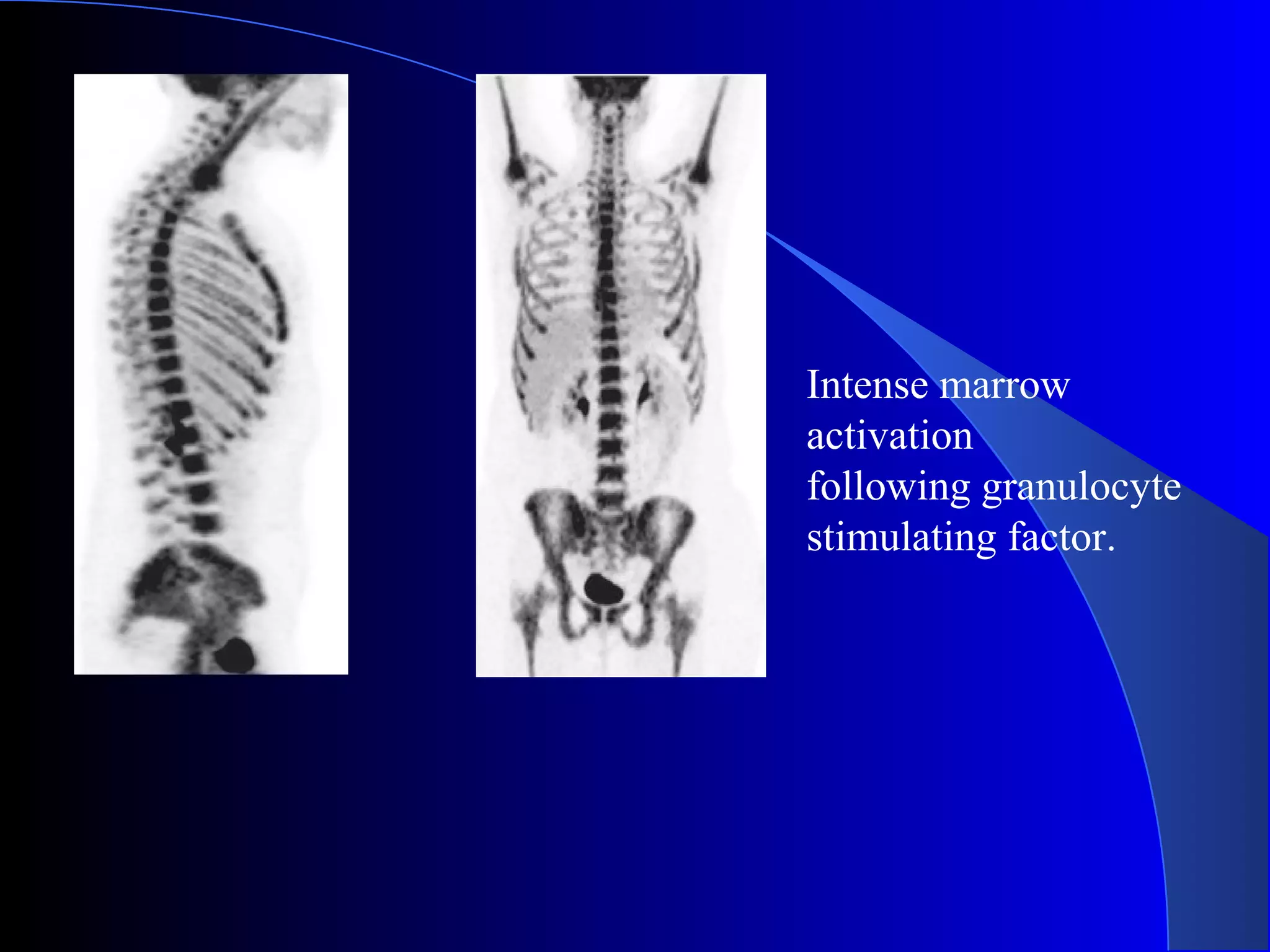 Intense marrow
activation
following granulocyte
stimulating factor.
 