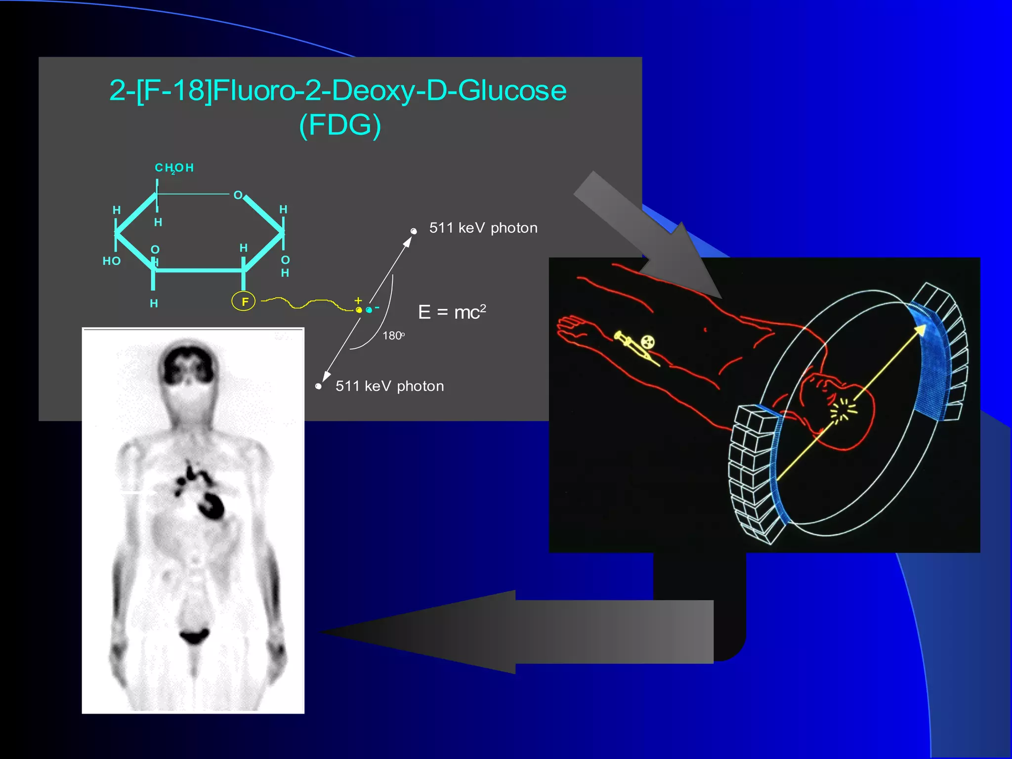 2-[F-18]Fluoro-2-Deoxy-D-Glucose
(FDG)
O
H
O
O
H
HO
F
H
H
H
H
H
CH2
OH
511 keV photon
511 keV photon
E = mc2
180o
+ -
UC LA
 