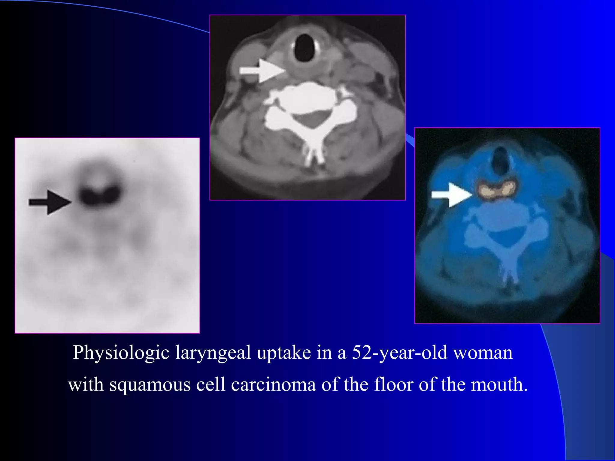 Physiologic laryngeal uptake in a 52-year-old woman
with squamous cell carcinoma of the floor of the mouth.
 