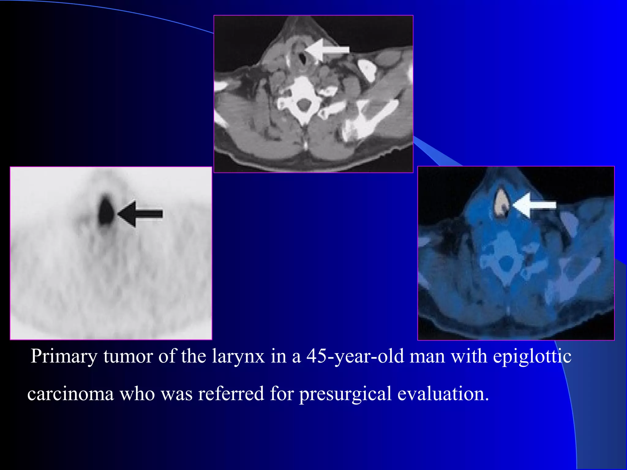 Primary tumor of the larynx in a 45-year-old man with epiglottic
carcinoma who was referred for presurgical evaluation.
 