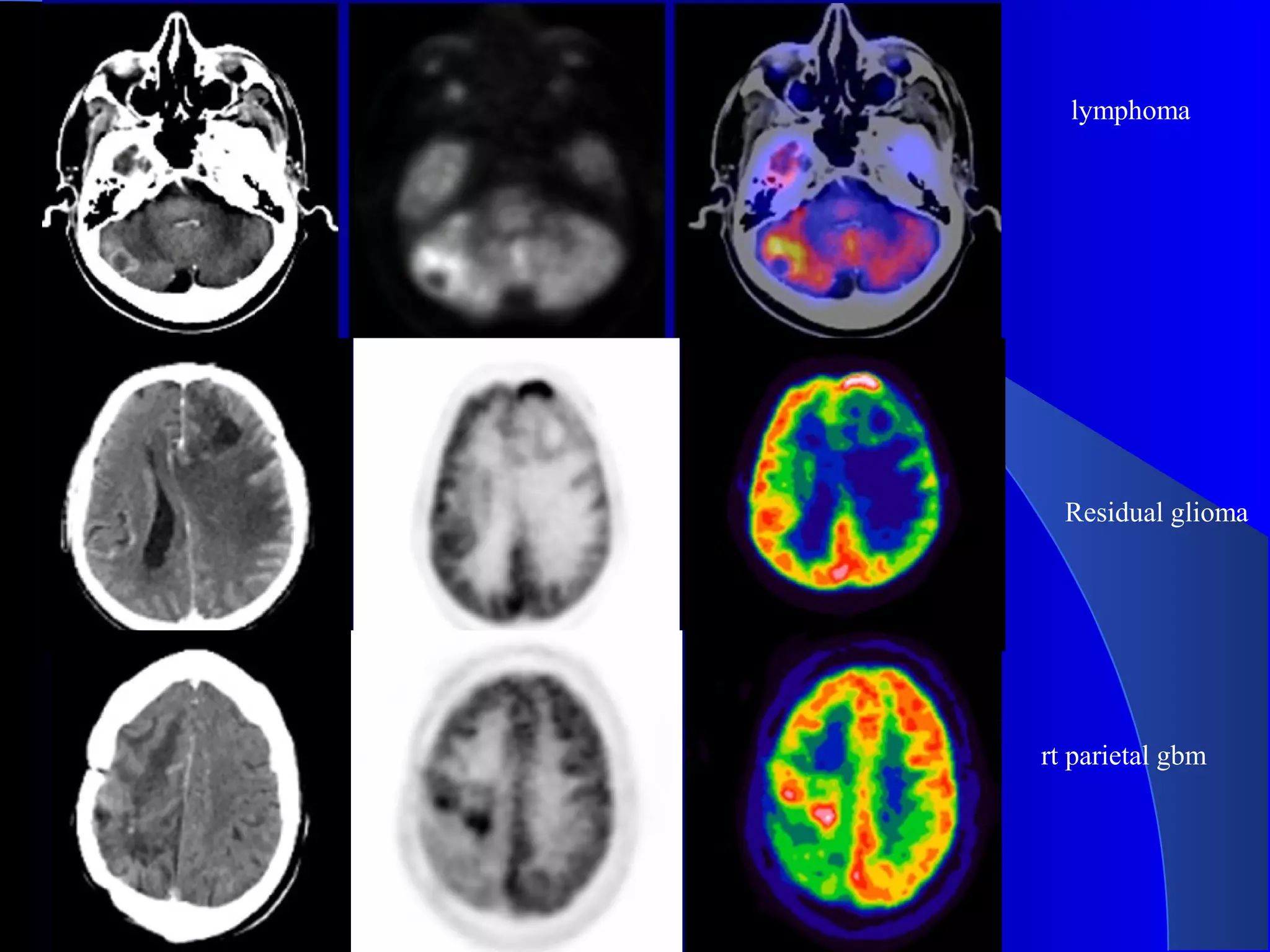 rere
lymphoma
Residual glioma
rt parietal gbm
 