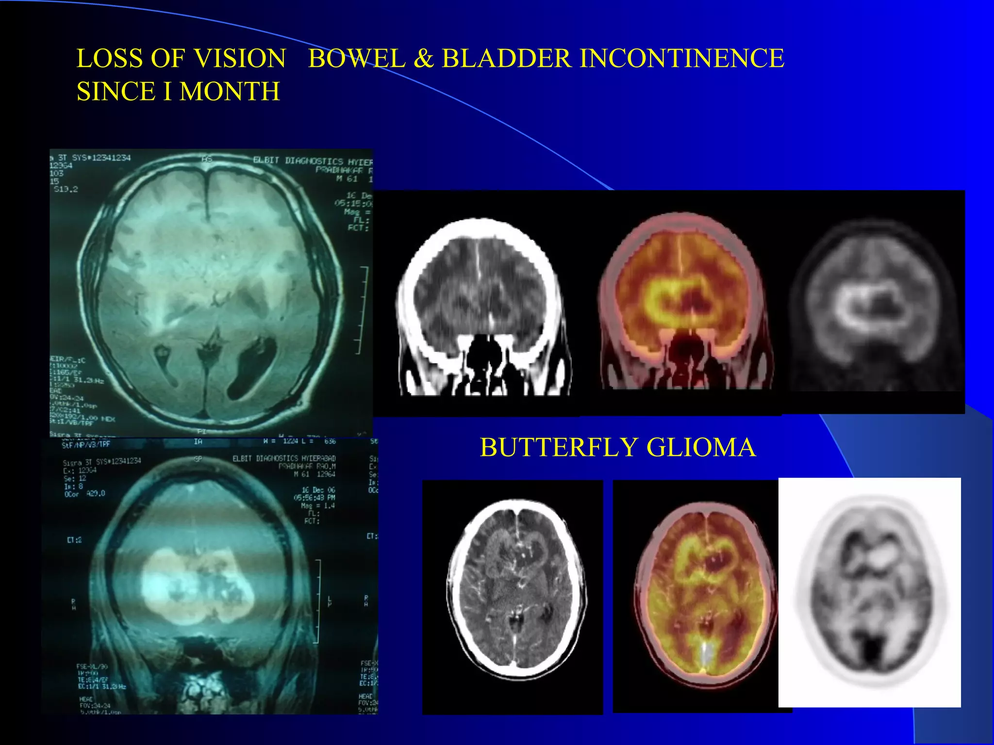 LOSS OF VISION BOWEL & BLADDER INCONTINENCE
SINCE I MONTH
BUTTERFLY GLIOMA
 
