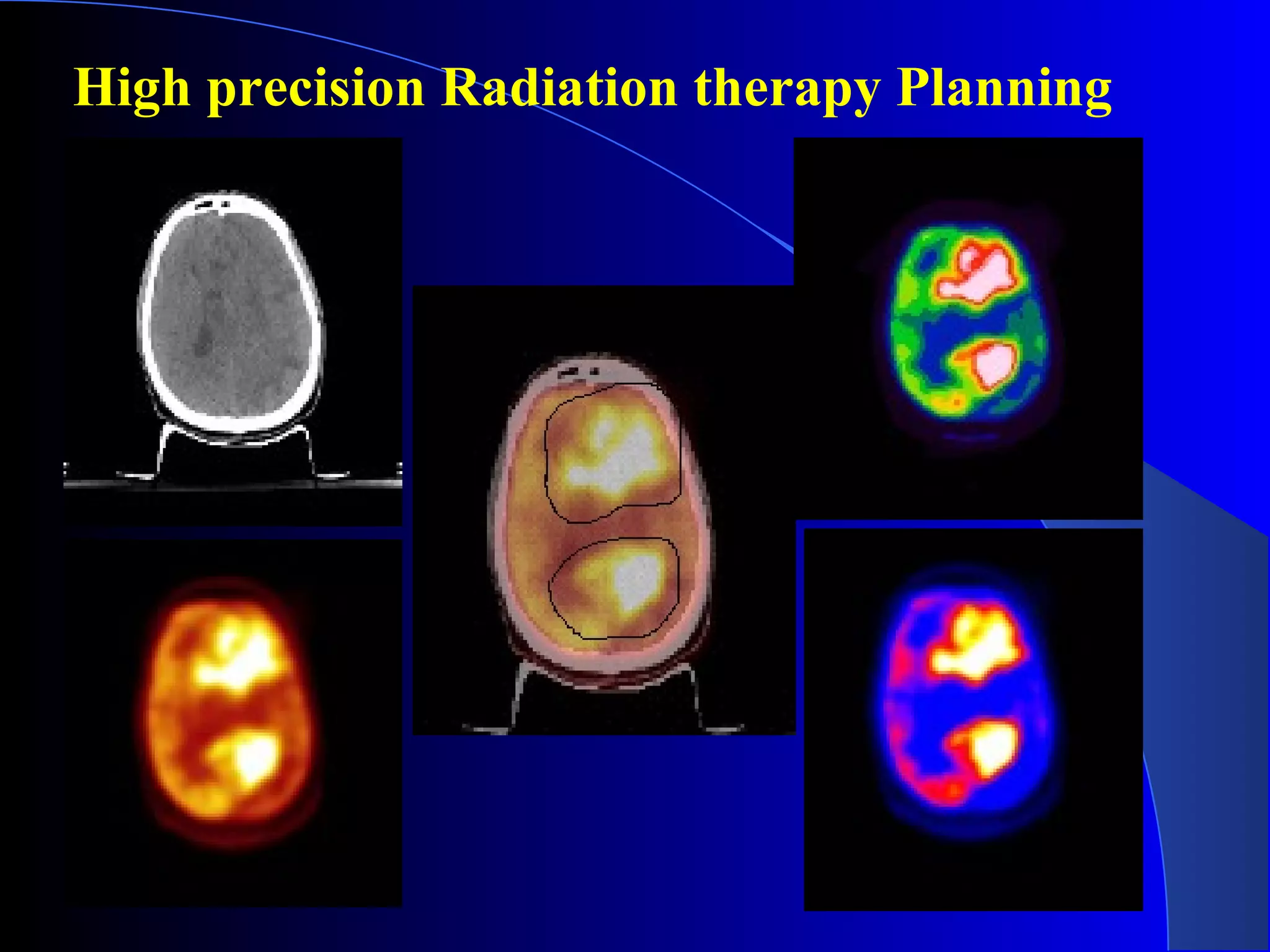 High precision Radiation therapy Planning
 