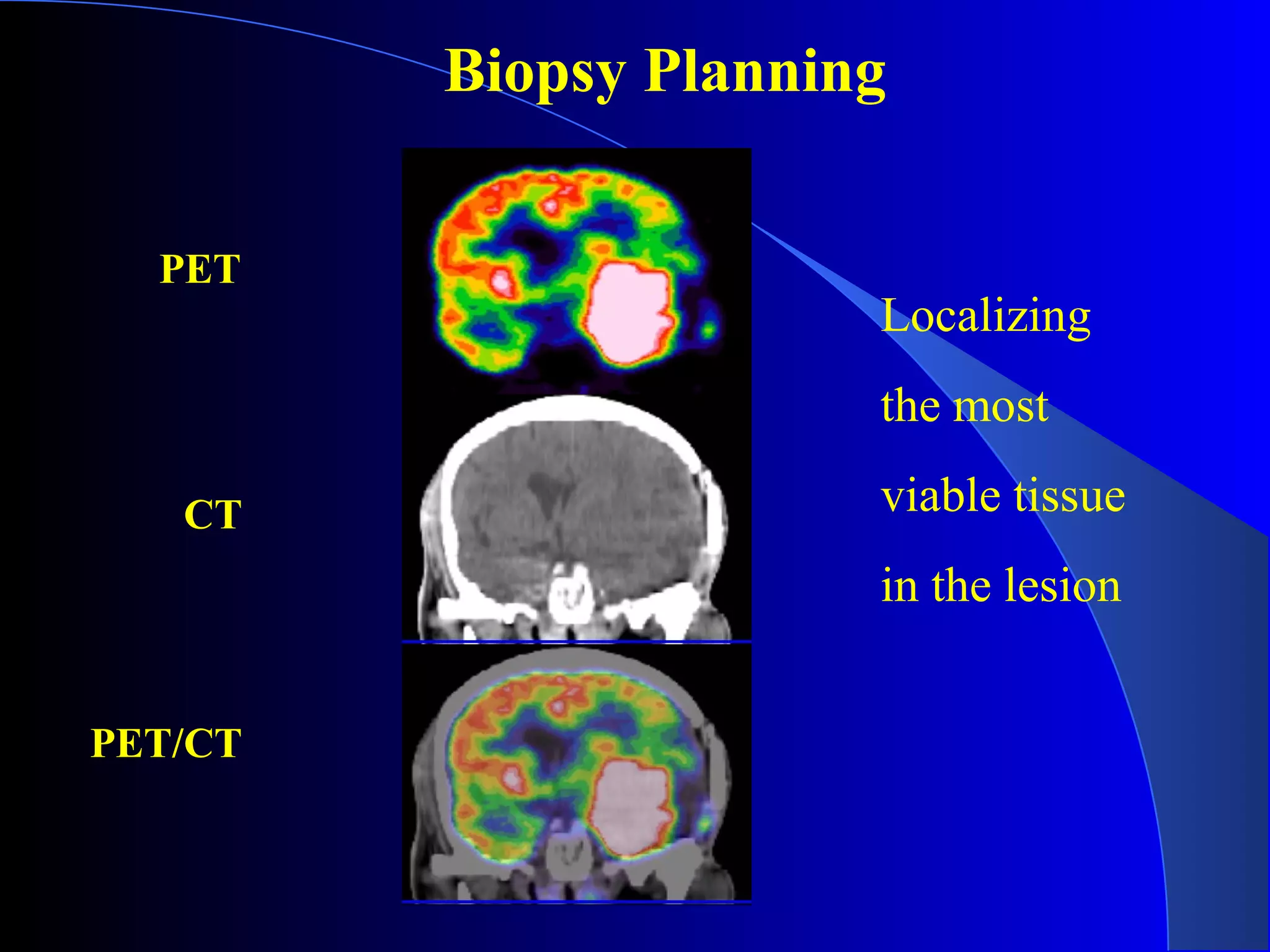 PET
CT
PET/CT
Biopsy Planning
Localizing
the most
viable tissue
in the lesion
 