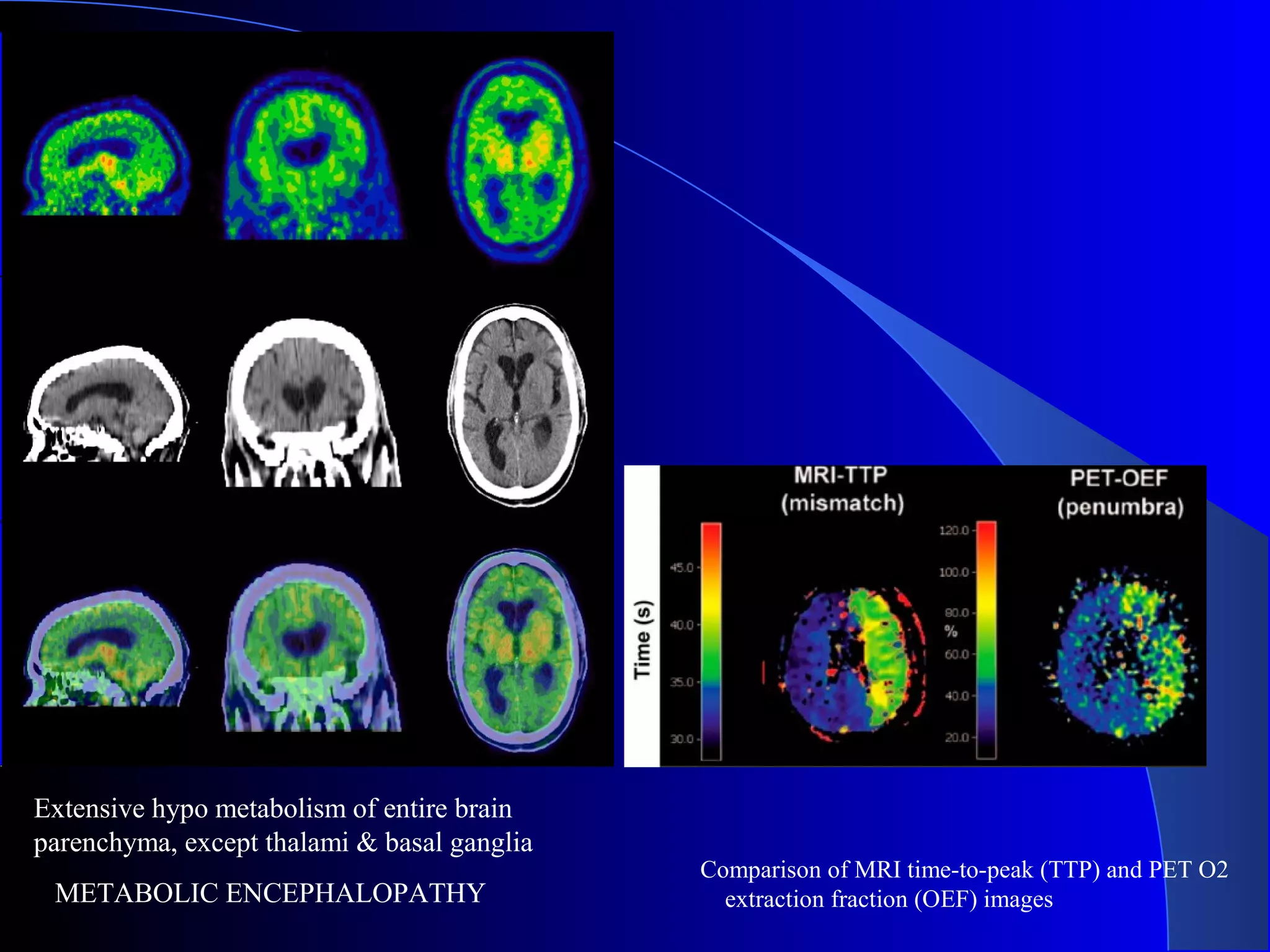 Comparison of MRI time-to-peak (TTP) and PET O2
extraction fraction (OEF) images
Extensive hypo metabolism of entire brain
parenchyma, except thalami & basal ganglia
METABOLIC ENCEPHALOPATHY
 