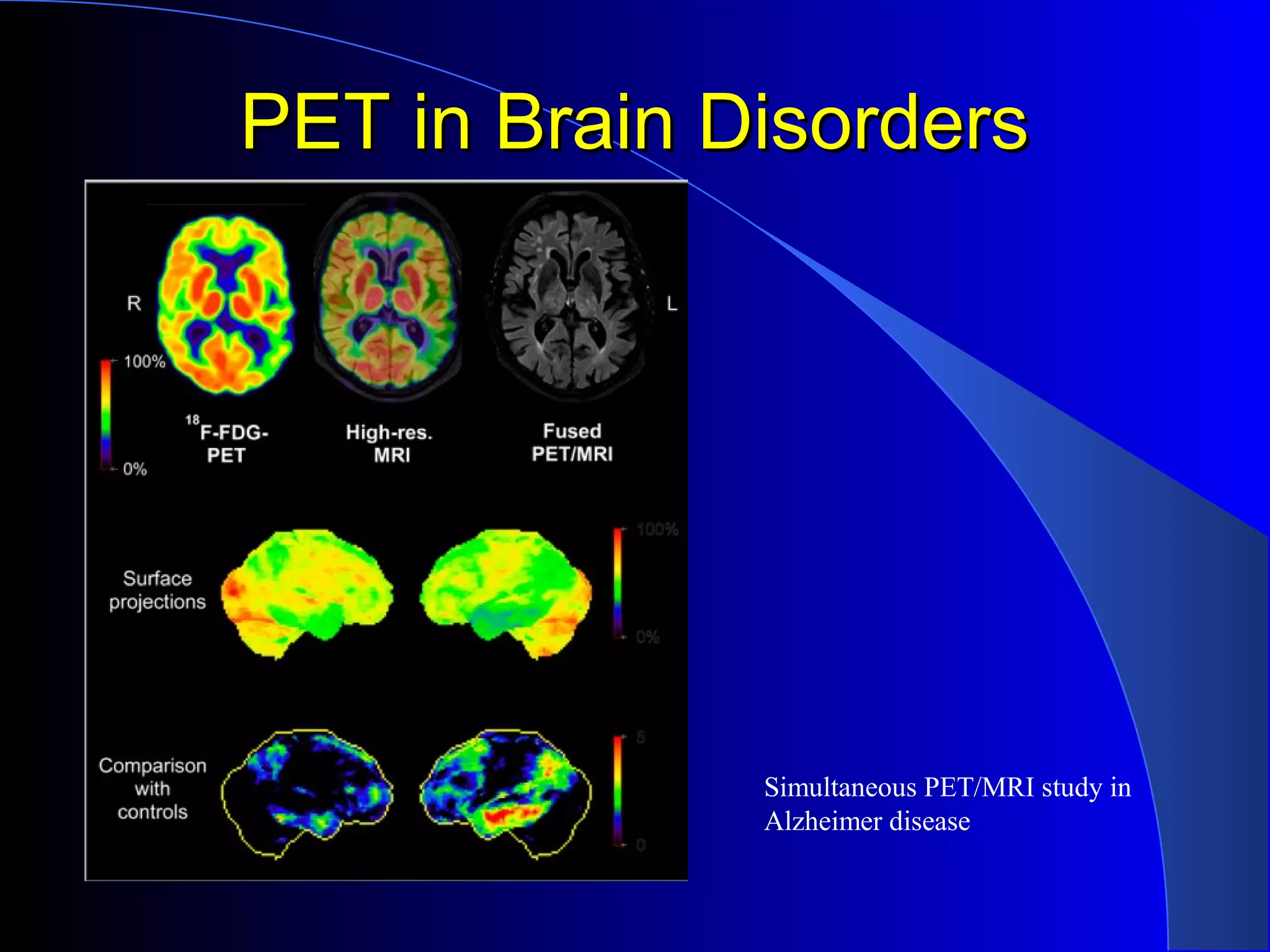 PET in Brain DisordersPET in Brain Disorders
Simultaneous PET/MRI study in
Alzheimer disease
 