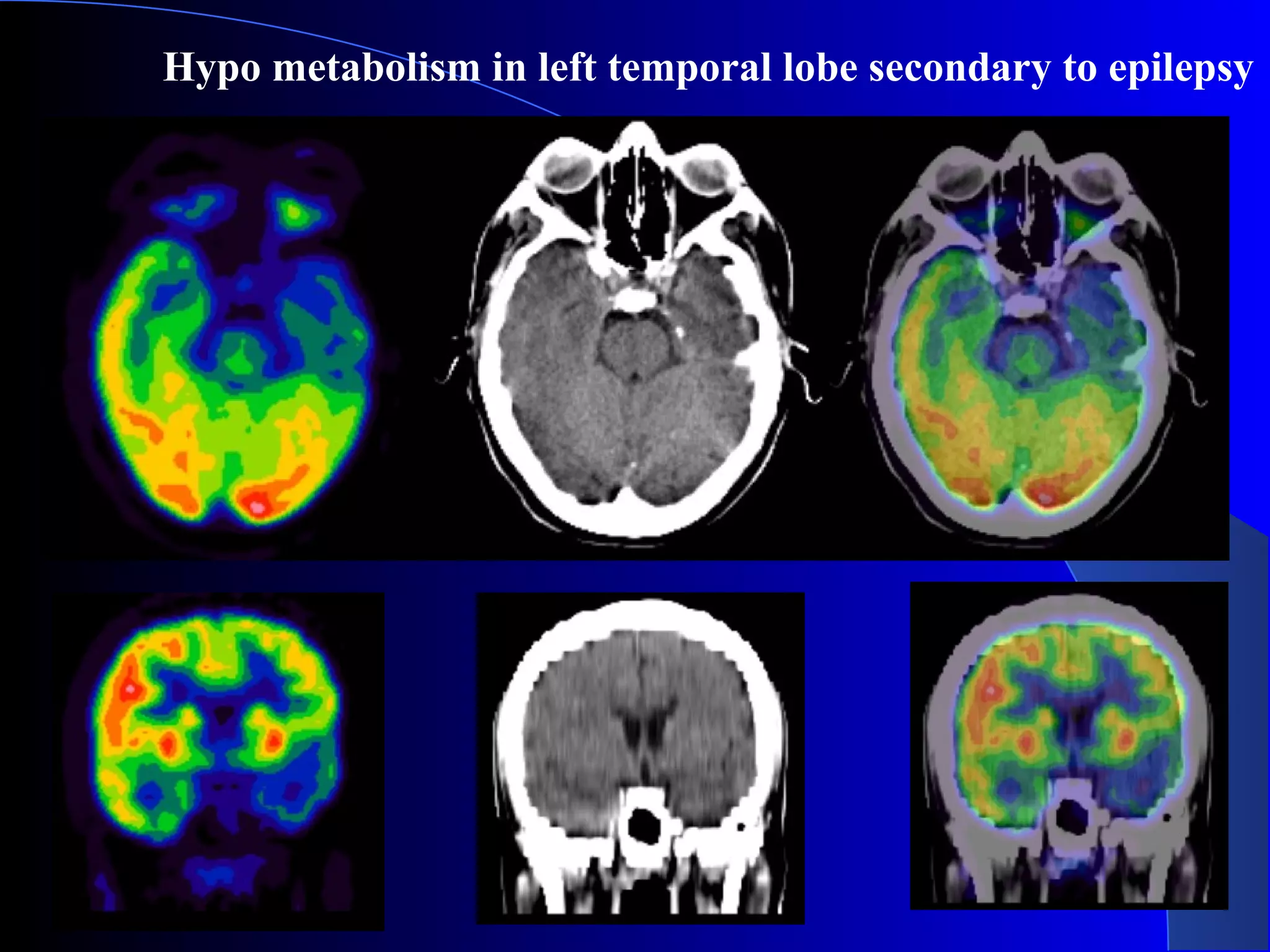 Hypo metabolism in left temporal lobe secondary to epilepsy
 