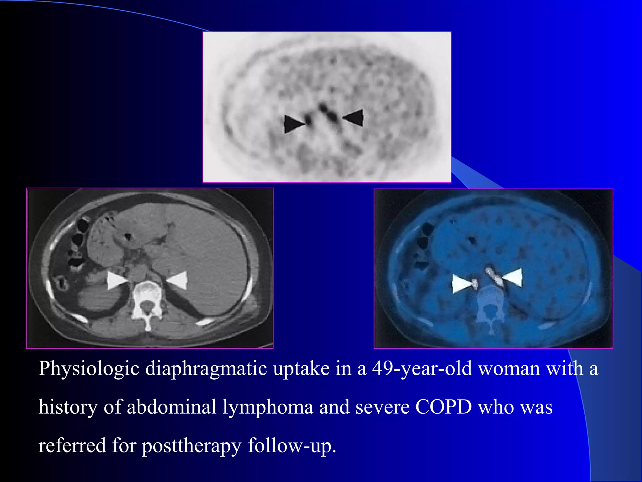 Physiologic diaphragmatic uptake in a 49-year-old woman with a
history of abdominal lymphoma and severe COPD who was
referred for posttherapy follow-up.
 
