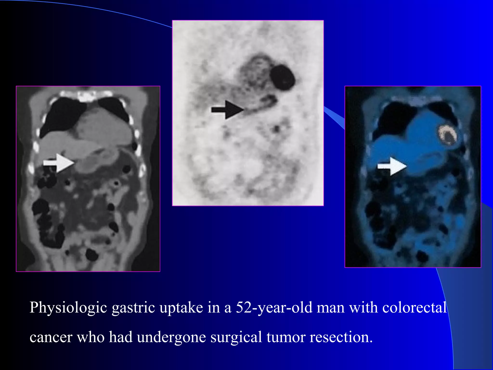 Physiologic gastric uptake in a 52-year-old man with colorectal
cancer who had undergone surgical tumor resection.
 
