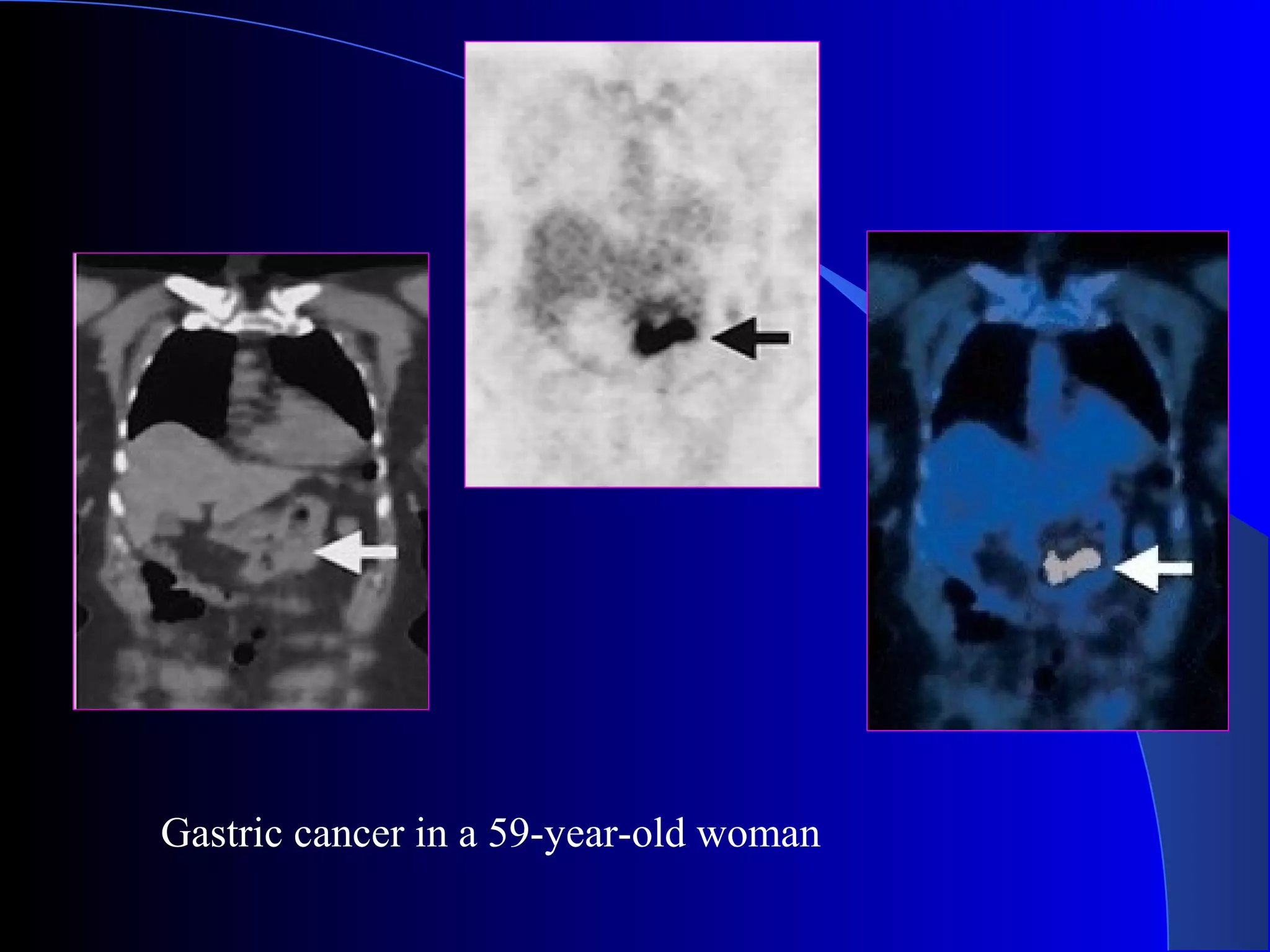 Gastric cancer in a 59-year-old woman
 