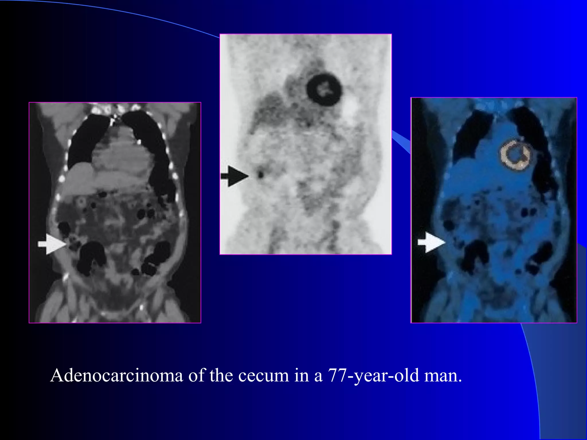 Adenocarcinoma of the cecum in a 77-year-old man.
 