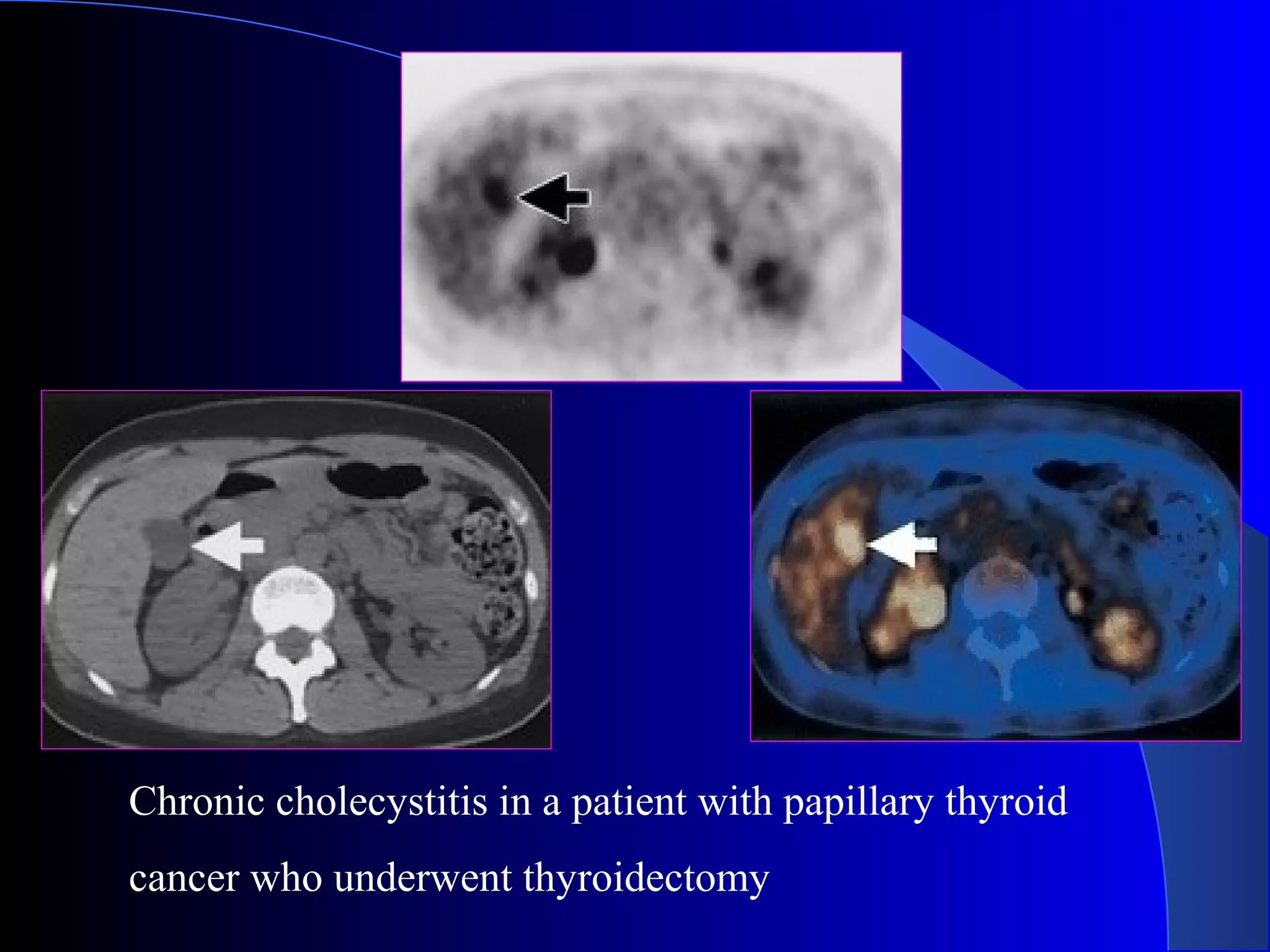 Chronic cholecystitis in a patient with papillary thyroid
cancer who underwent thyroidectomy
 