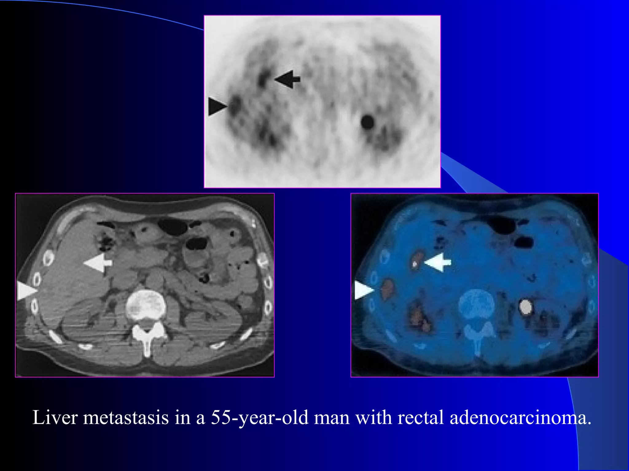 Liver metastasis in a 55-year-old man with rectal adenocarcinoma.
 
