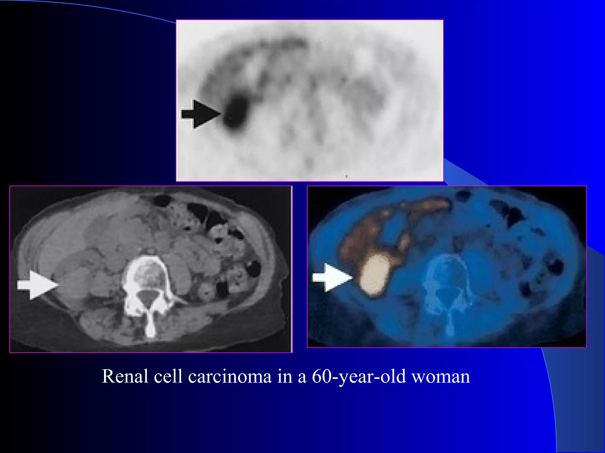 Renal cell carcinoma in a 60-year-old woman
 