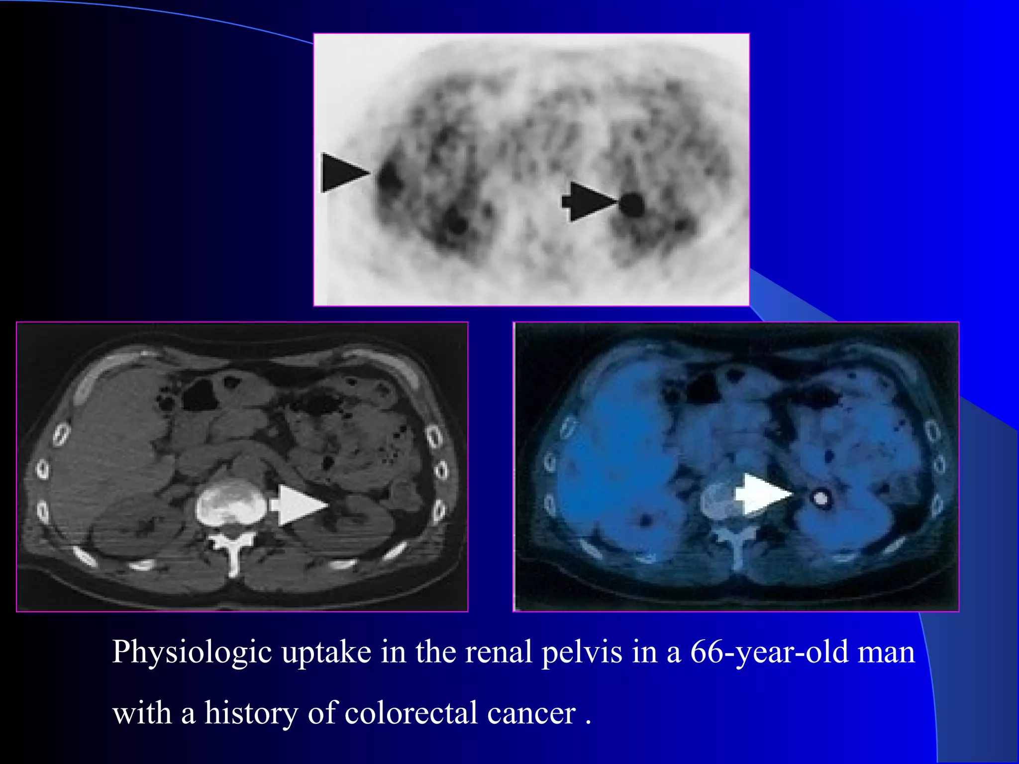 Physiologic uptake in the renal pelvis in a 66-year-old man
with a history of colorectal cancer .
 