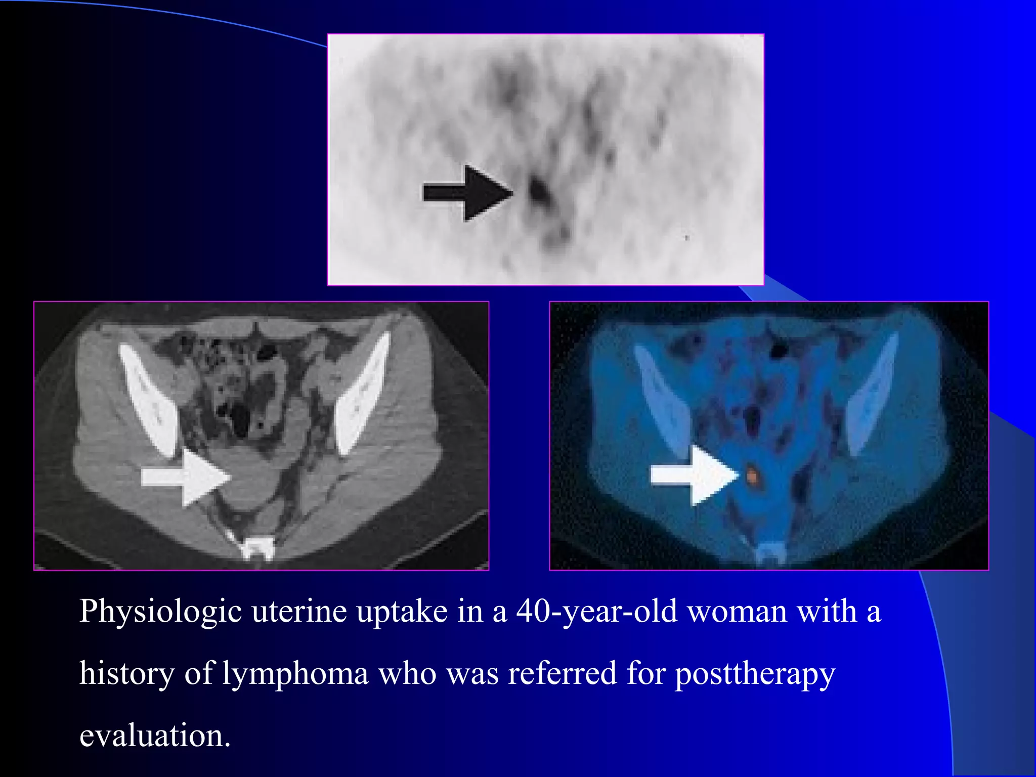 Physiologic uterine uptake in a 40-year-old woman with a
history of lymphoma who was referred for posttherapy
evaluation.
 