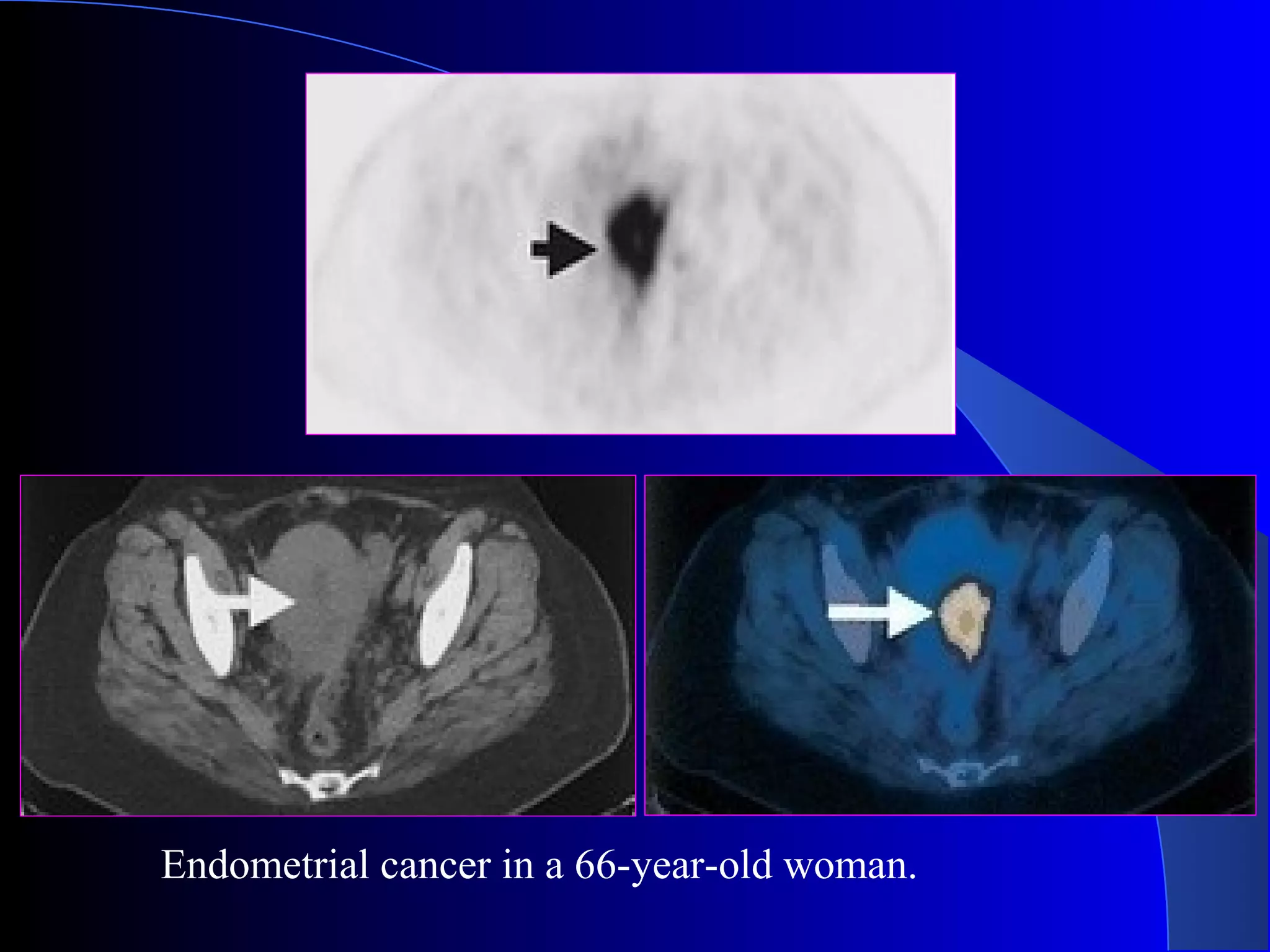 Endometrial cancer in a 66-year-old woman.
 