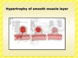Hypertrophy of smooth muscle layer