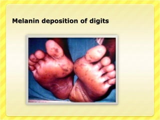 Melanin deposition of digits