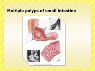 Multiple polyps of small intestine