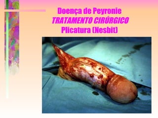 Doença de Peyronie TRATAMENTO CIRÚRGICO Plicatura (Nesbit) 