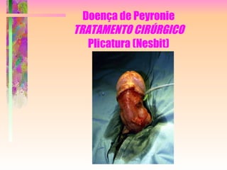 Doença de Peyronie TRATAMENTO CIRÚRGICO Plicatura (Nesbit) 