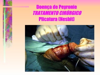 Doença de Peyronie TRATAMENTO CIRÚRGICO Plicatura (Nesbit) 